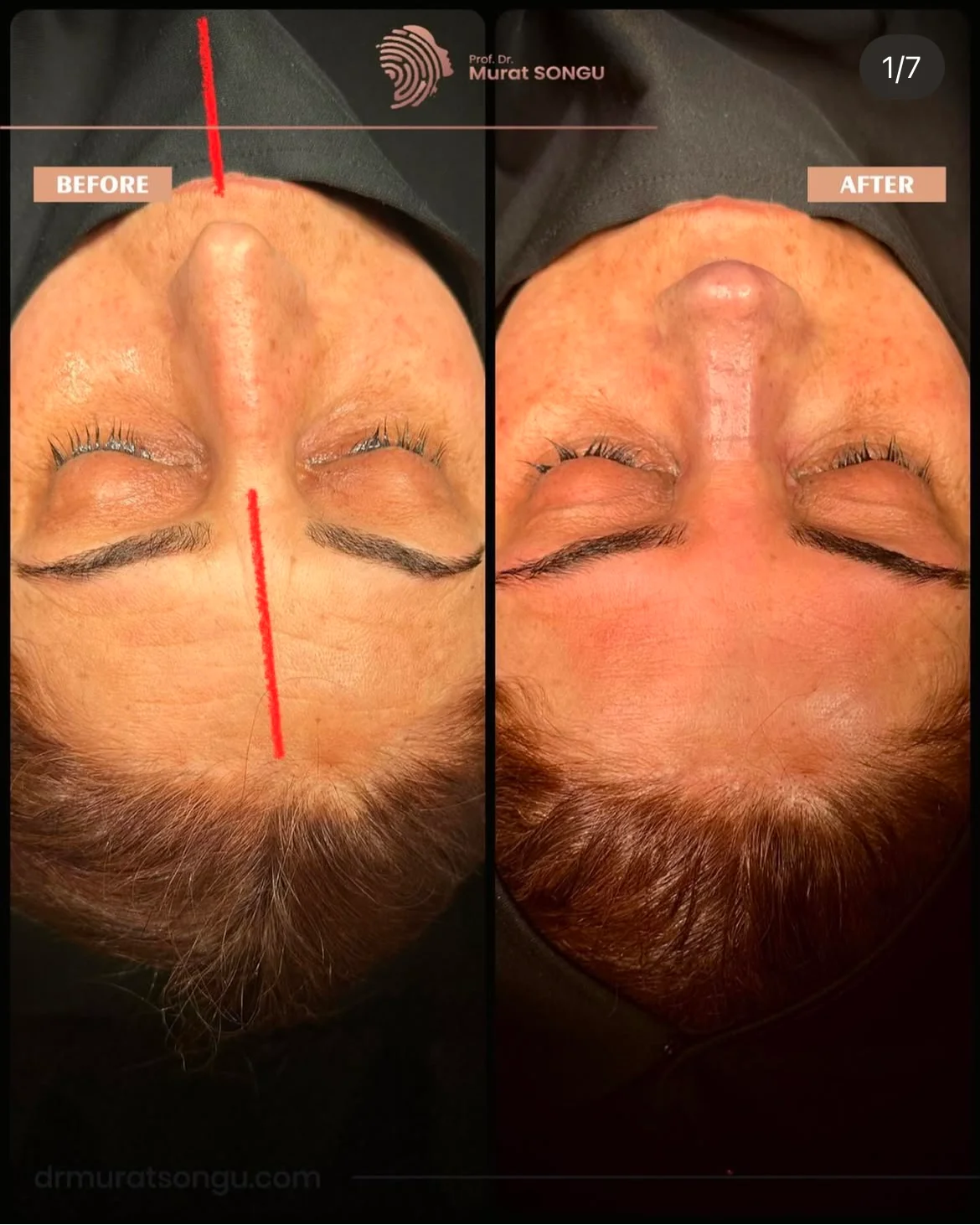 Cirurgia do Nariz Torto Antes & Depois