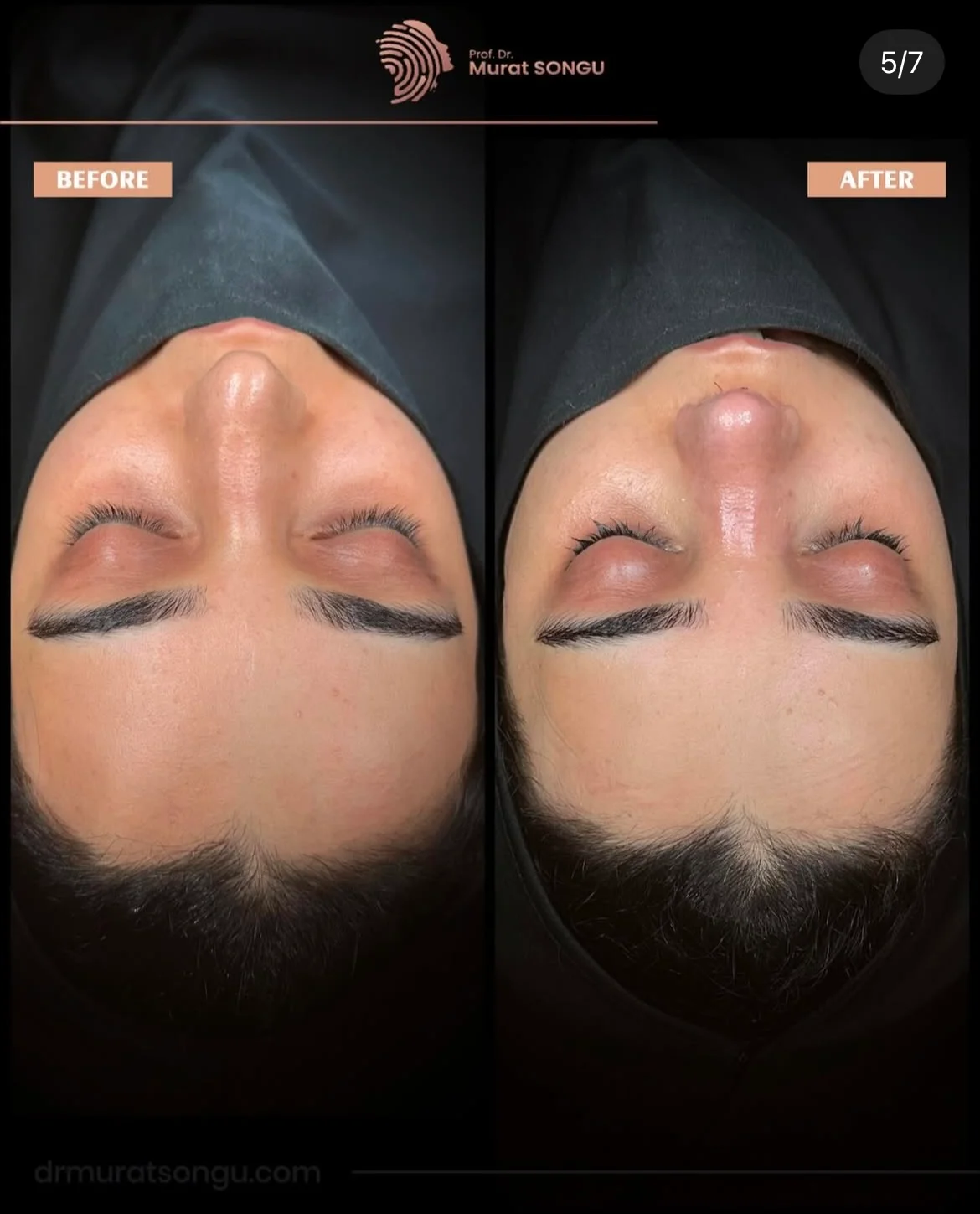 Cirurgia do Nariz Torto Antes & Depois