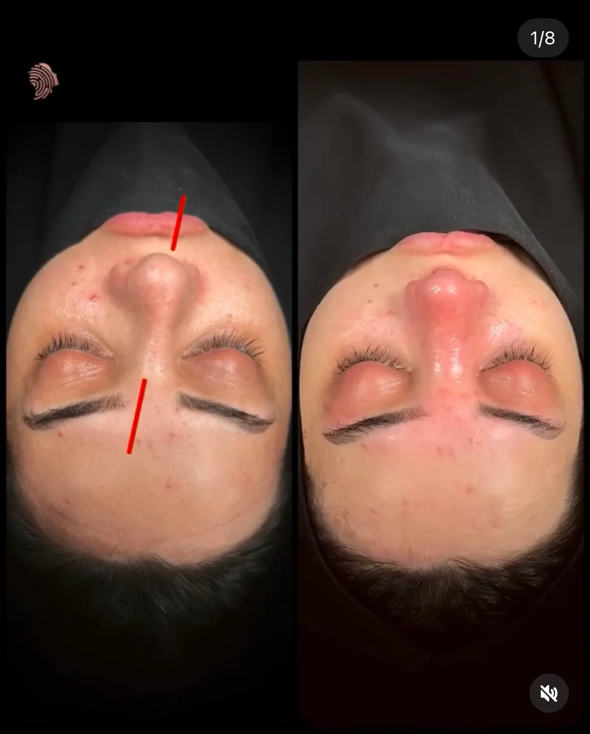 Cirurgia do Nariz Torto Antes & Depois