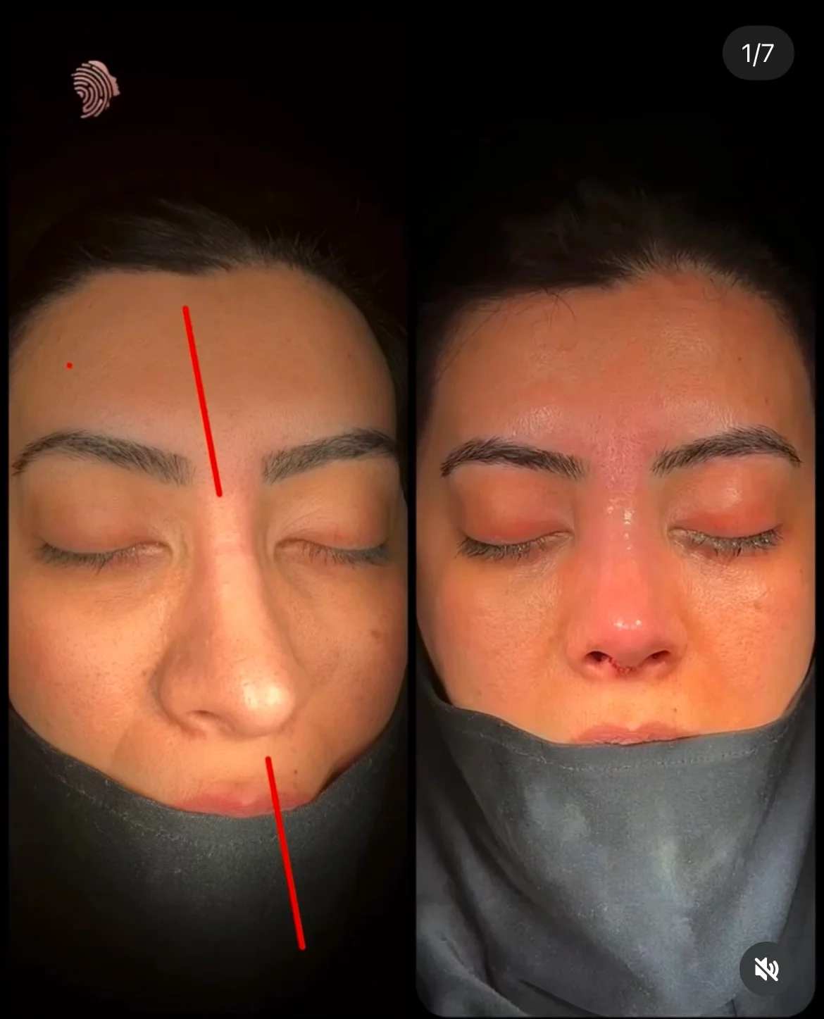 Cirurgia do Nariz Torto Antes & Depois