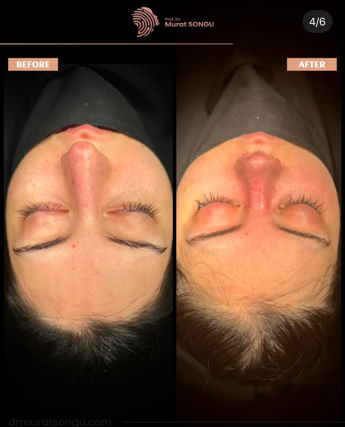 Cirurgia do Nariz Torto Antes & Depois