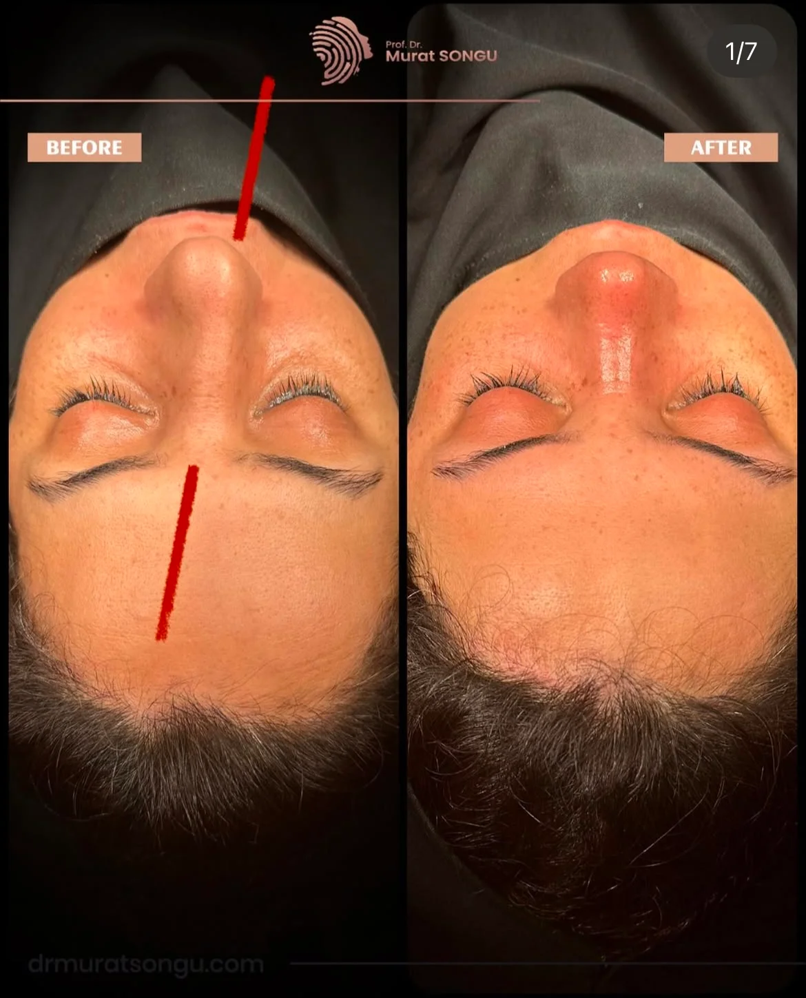 Cirurgia do Nariz Torto Antes & Depois