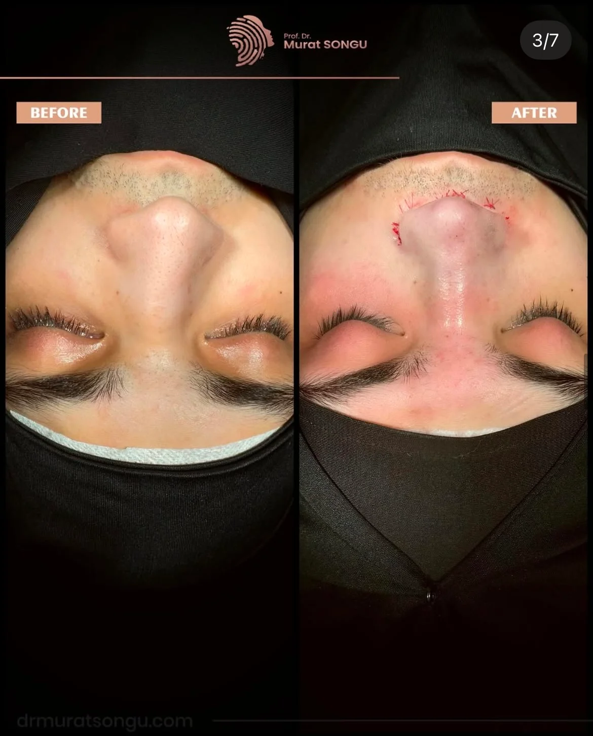 Cirurgia do Nariz Torto Antes & Depois