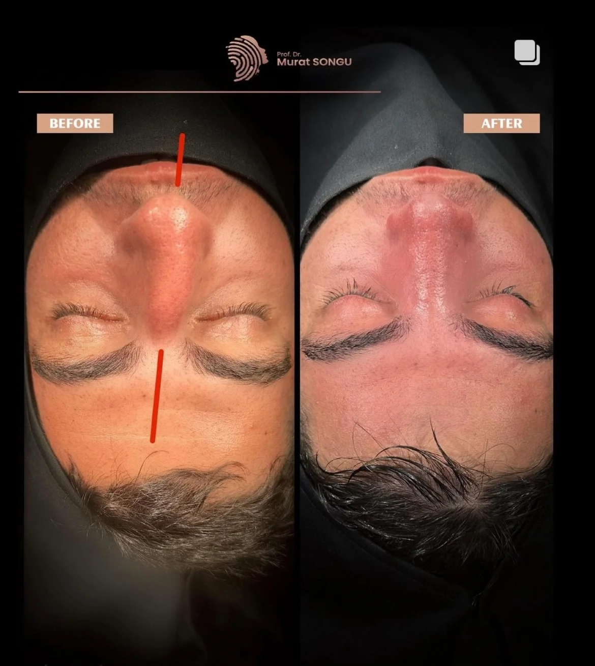 Cirurgia do Nariz Torto Antes & Depois