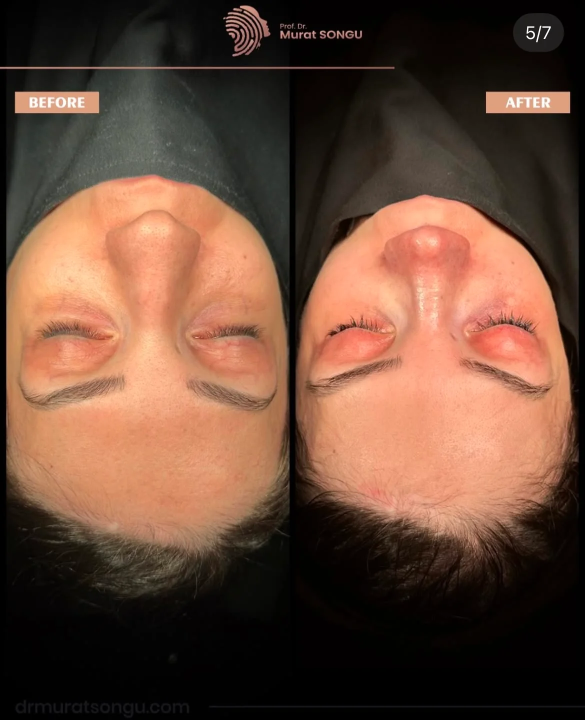 Cirurgia do Nariz Torto Antes & Depois