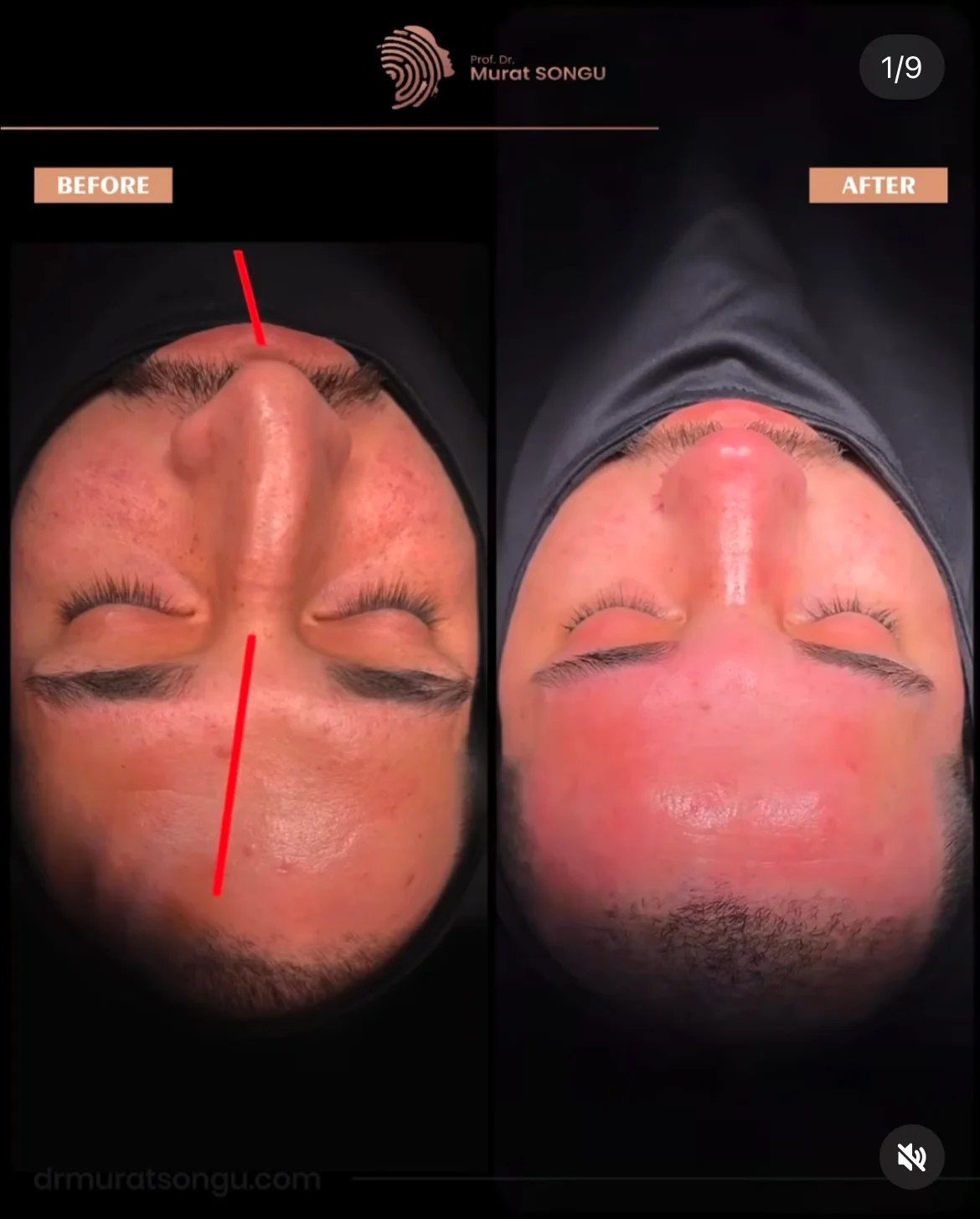 Cirurgia do Nariz Torto Antes & Depois