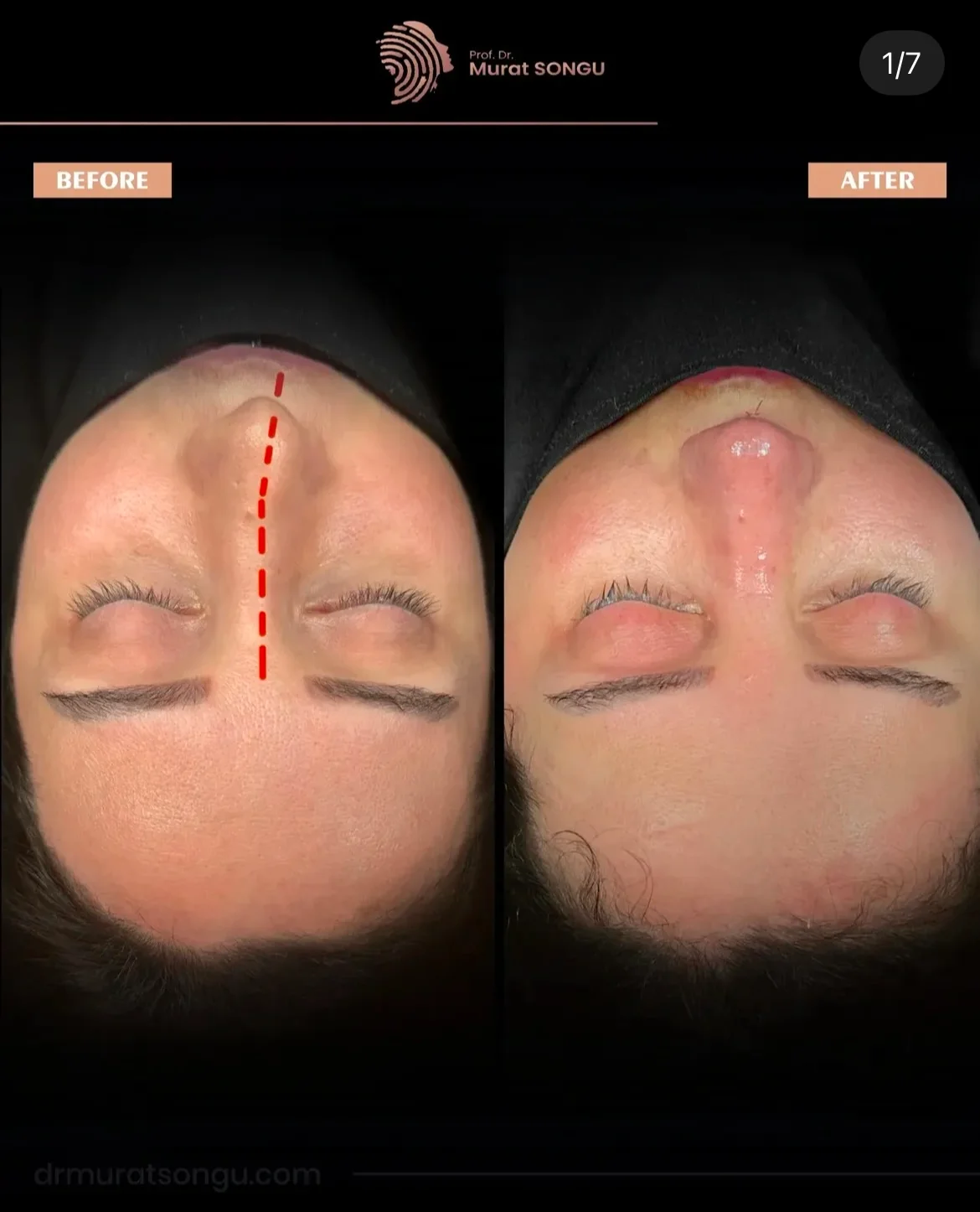 Cirurgia do Nariz Torto Antes & Depois