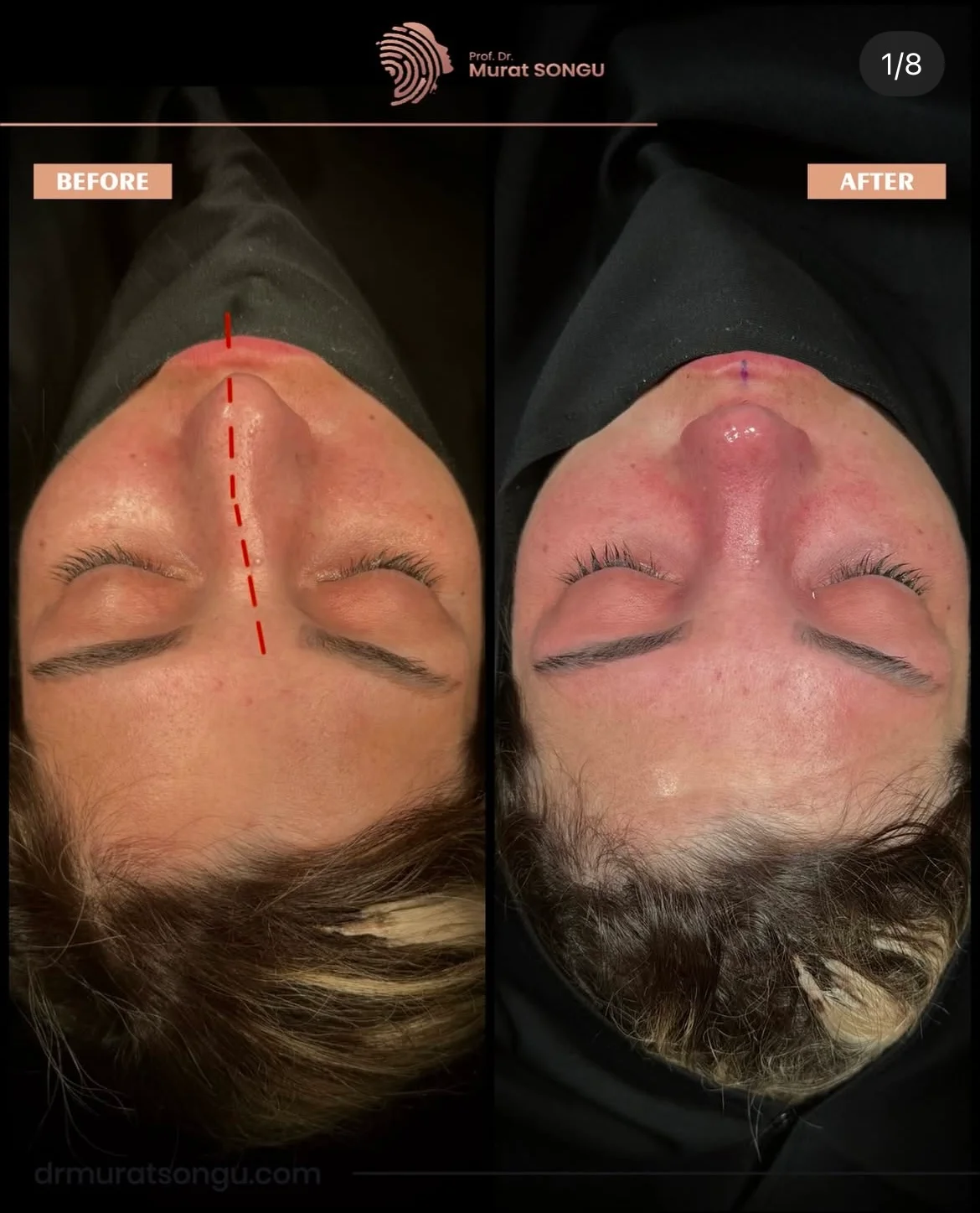 Cirurgia do Nariz Torto Antes & Depois