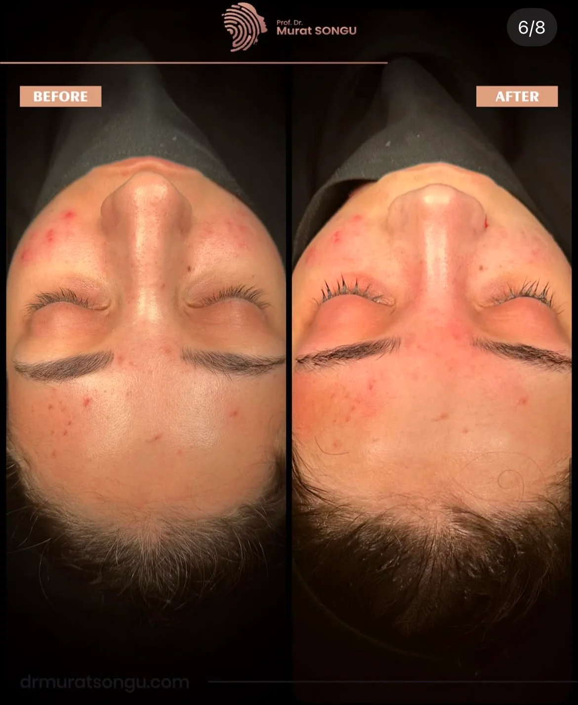 Cirurgia do Nariz Torto Antes & Depois