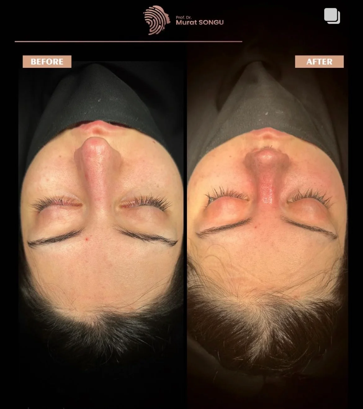 Cirurgia do Nariz Torto Antes & Depois