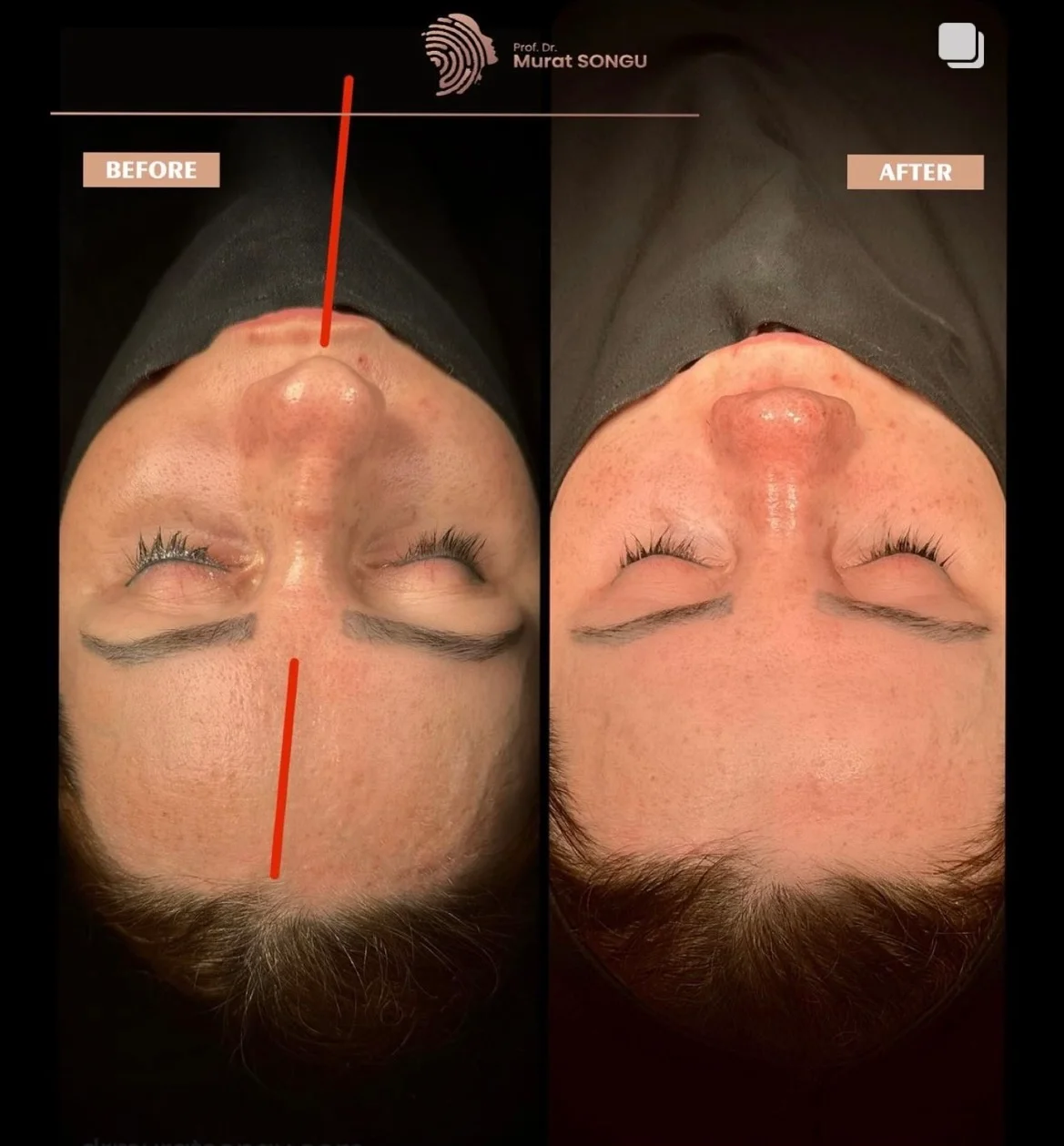 Cirurgia do Nariz Torto Antes & Depois