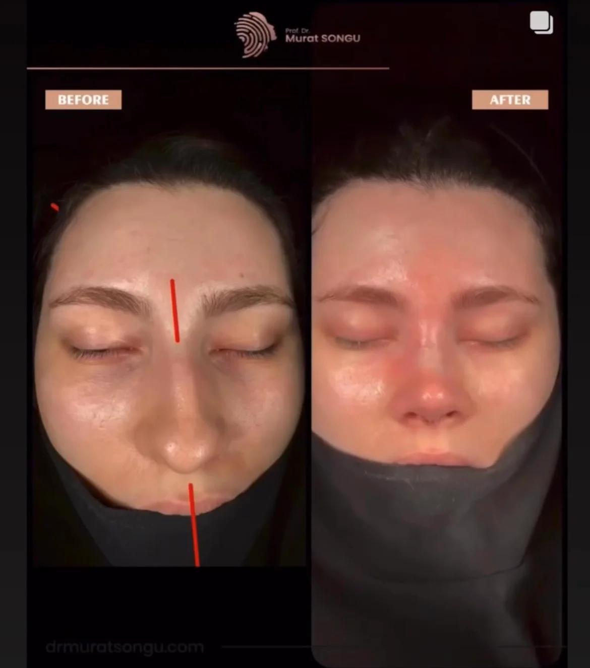 Cirurgia do Nariz Torto Antes & Depois