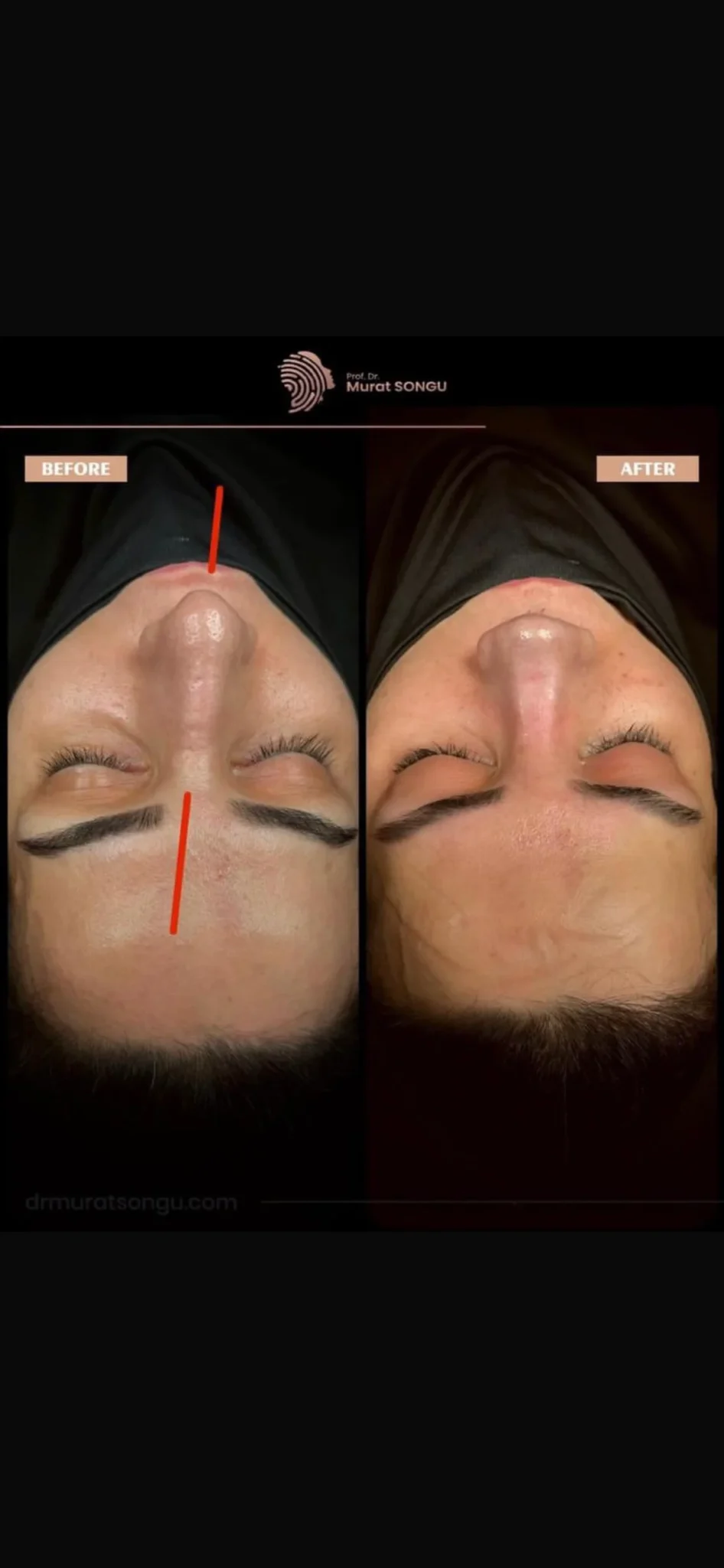 Cirurgia do Nariz Torto Antes & Depois