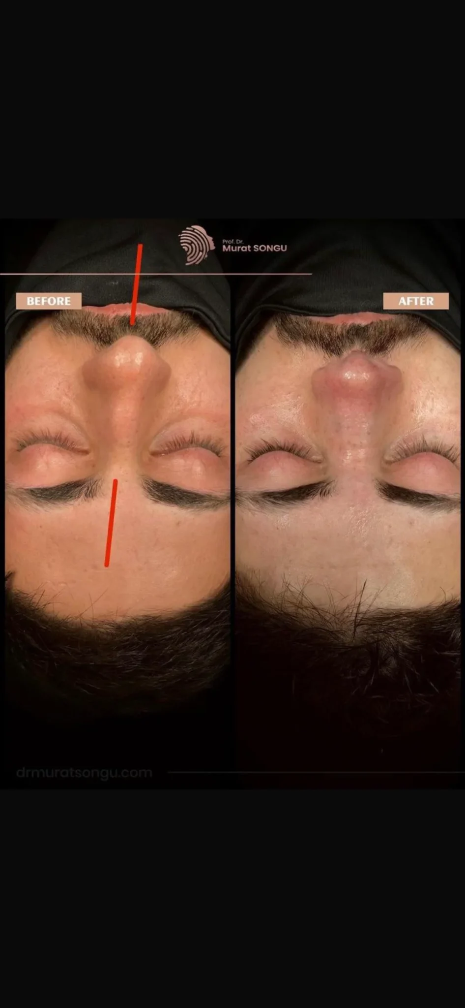 Cirurgia do Nariz Torto Antes & Depois