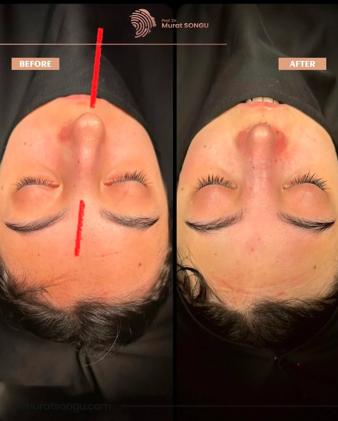 Cirurgia do Nariz Torto Antes & Depois