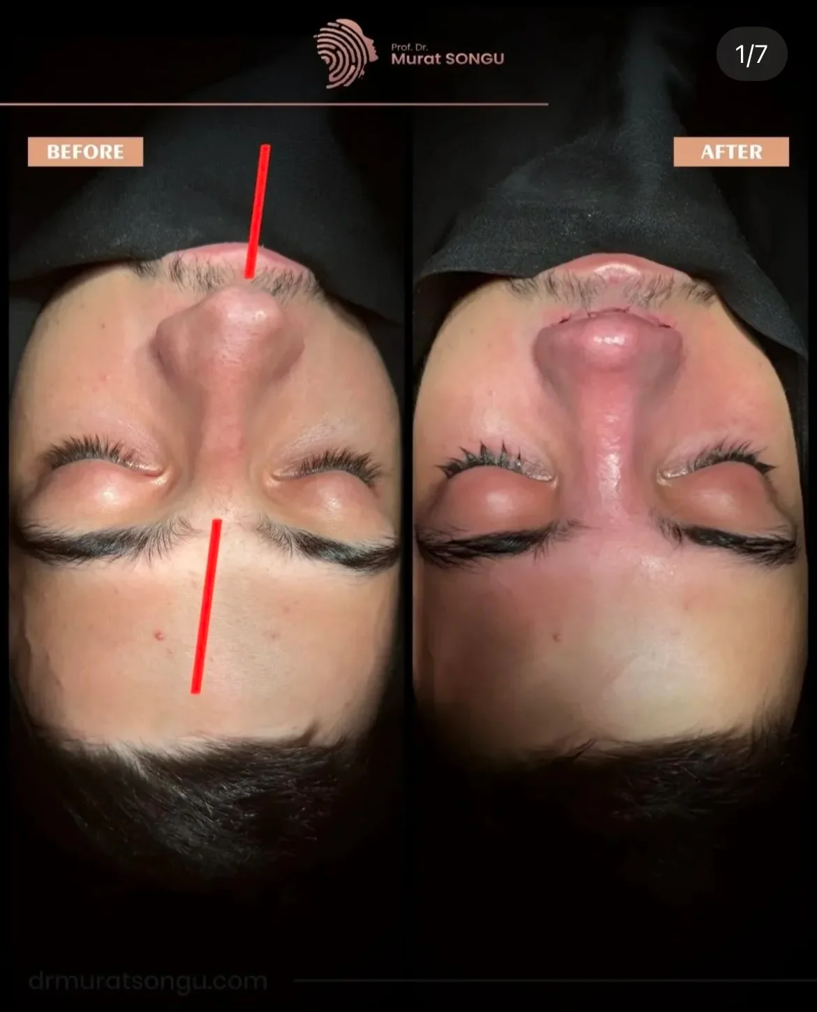 Crooked Nose Surgery Before & After Photos Gallery