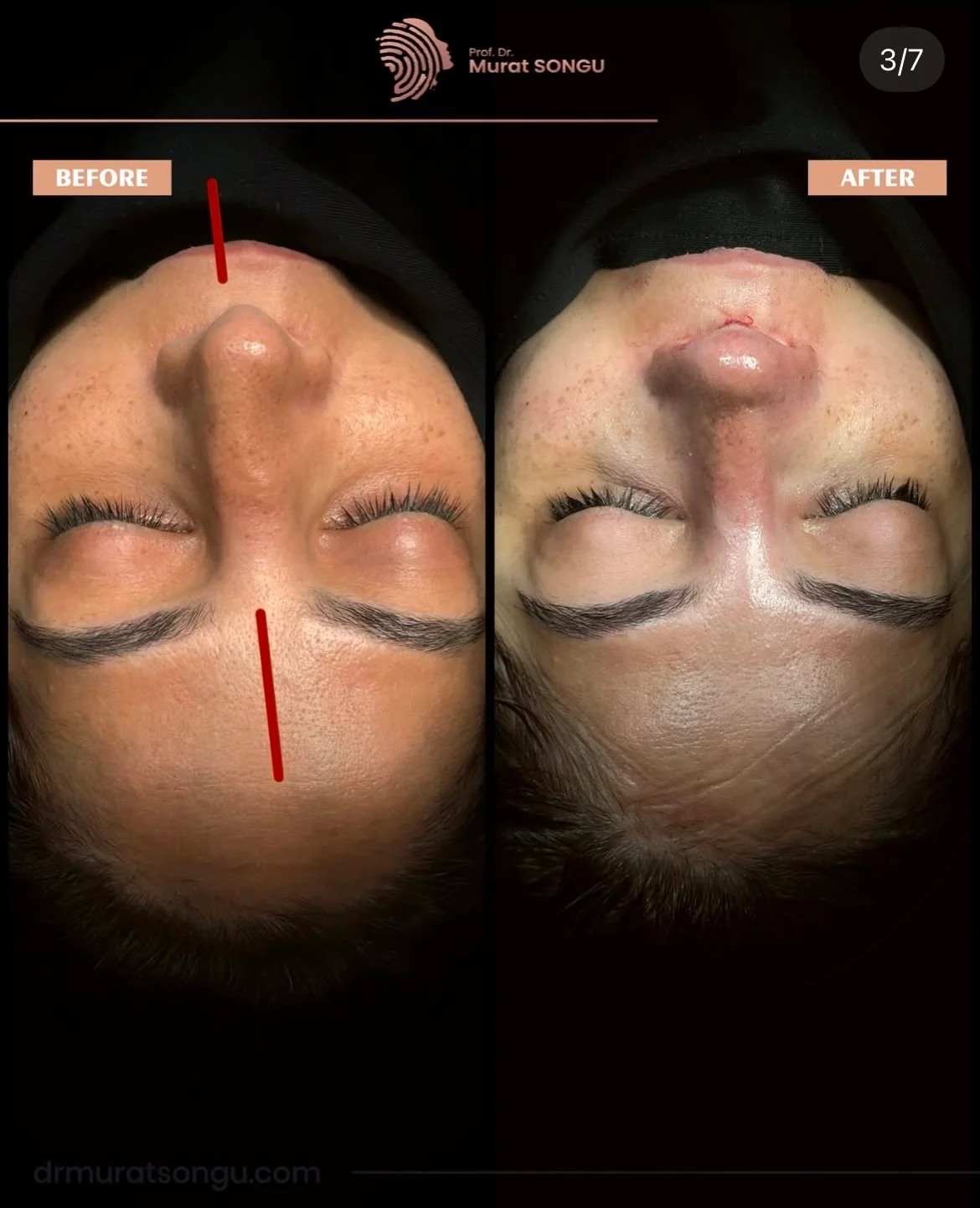 Crooked Nose Surgery Before & After Photos Gallery