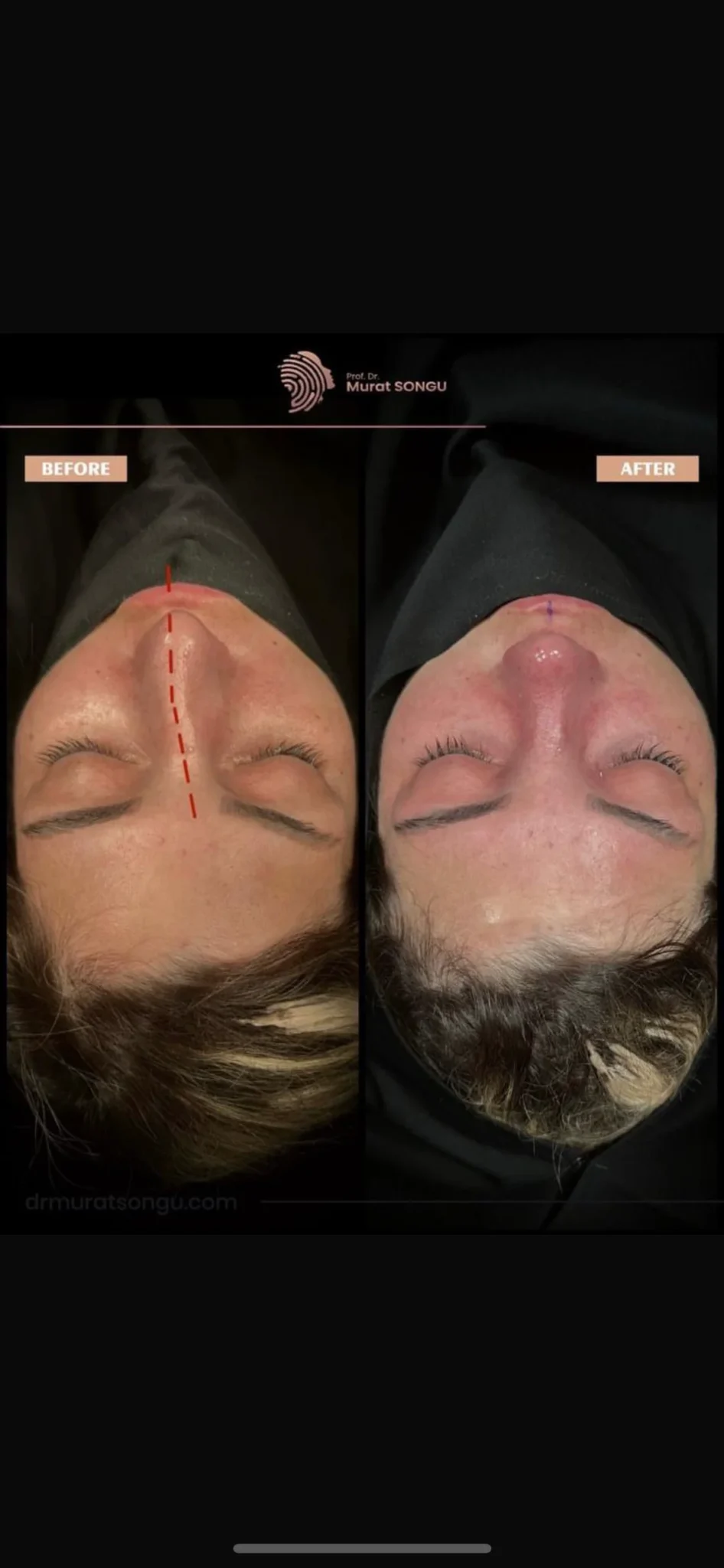 Crooked Nose Surgery Before & After Photos Gallery