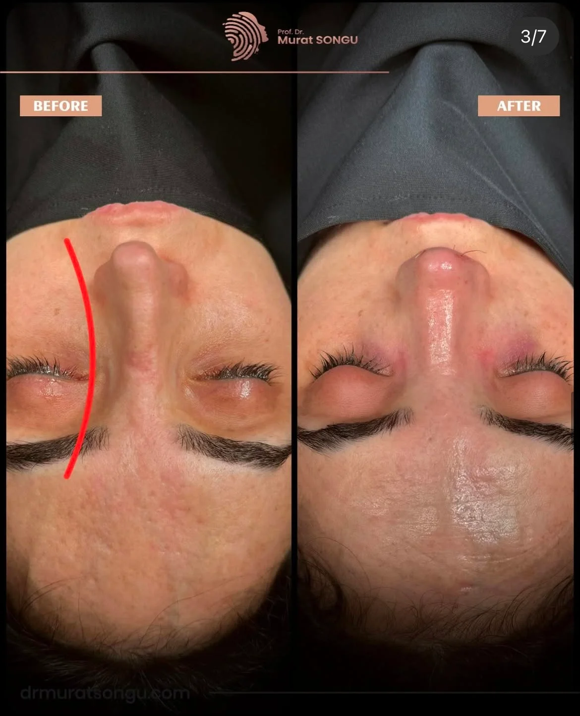 Crooked Nose Surgery Before & After Photos Gallery