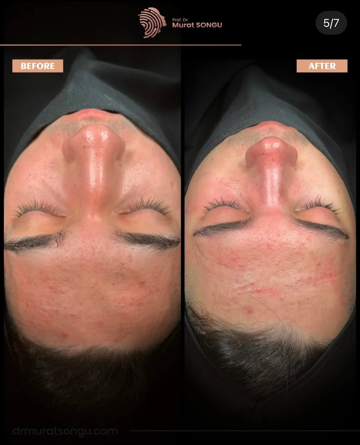 Crooked Nose Surgery Before & After Photos Gallery