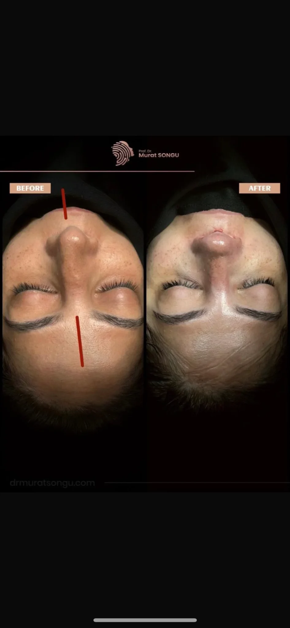 Crooked Nose Surgery Before & After Photos Gallery