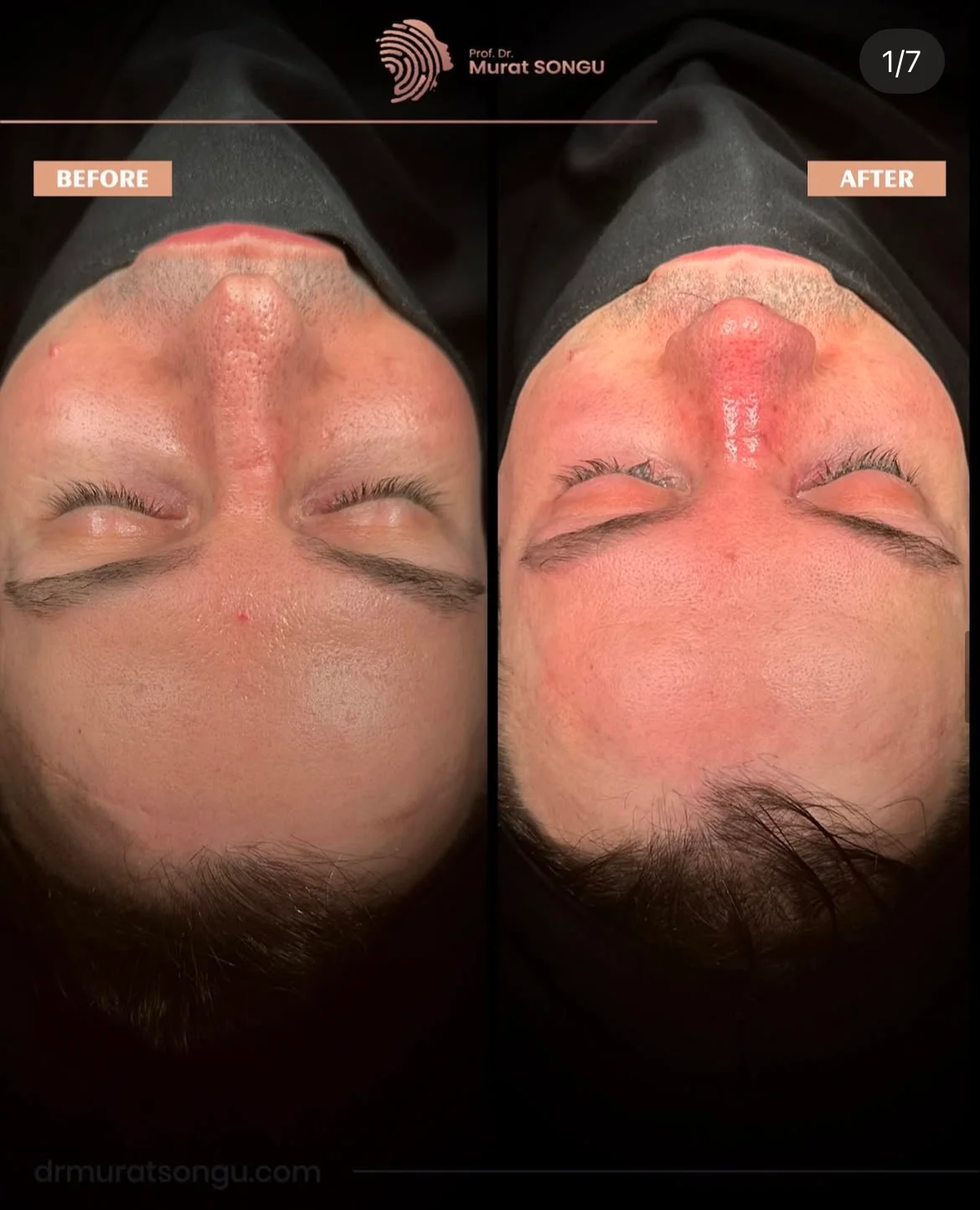 Crooked Nose Surgery Before & After Photos Gallery