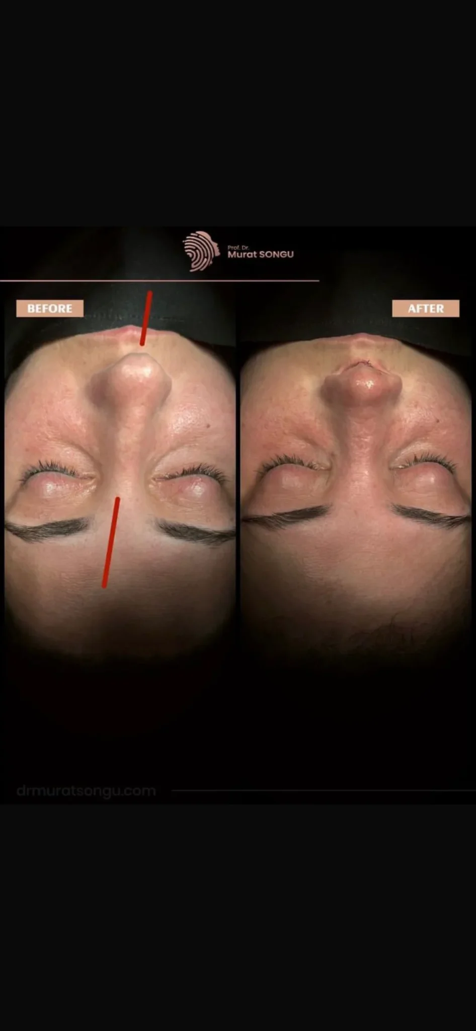Crooked Nose Surgery Before & After Photos Gallery