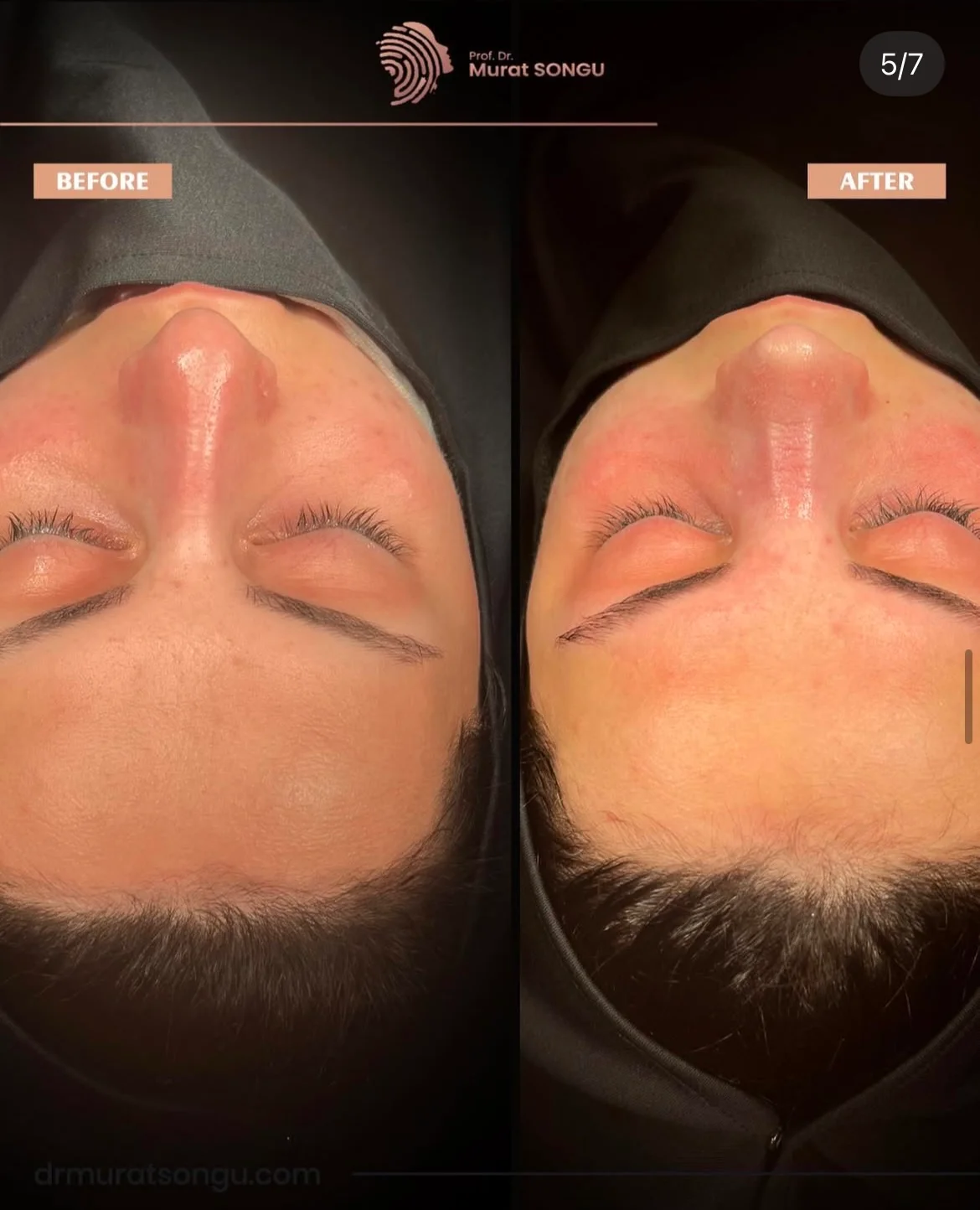 Crooked Nose Surgery Before & After Photos Gallery