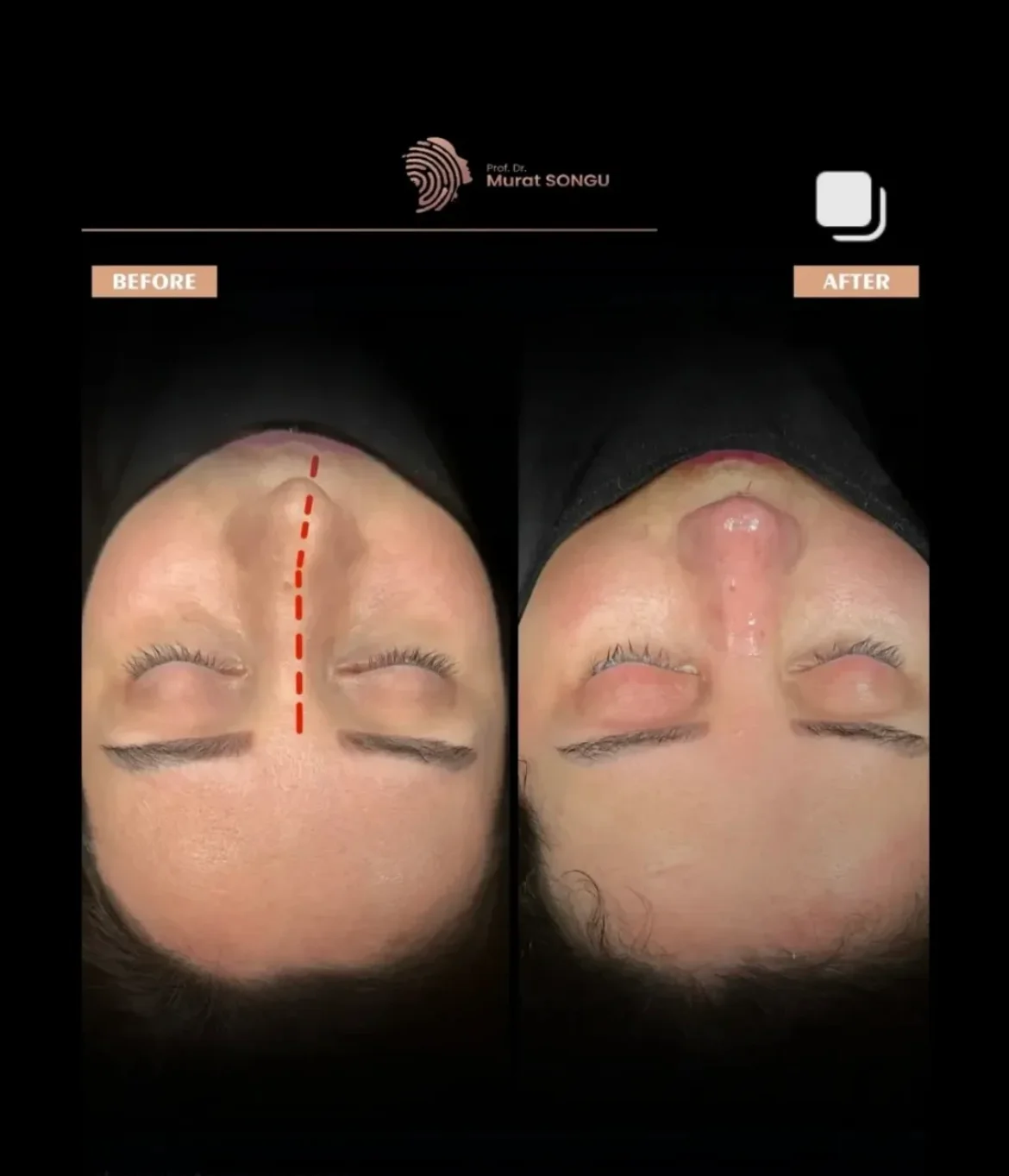 Crooked Nose Surgery Before & After Photos Gallery