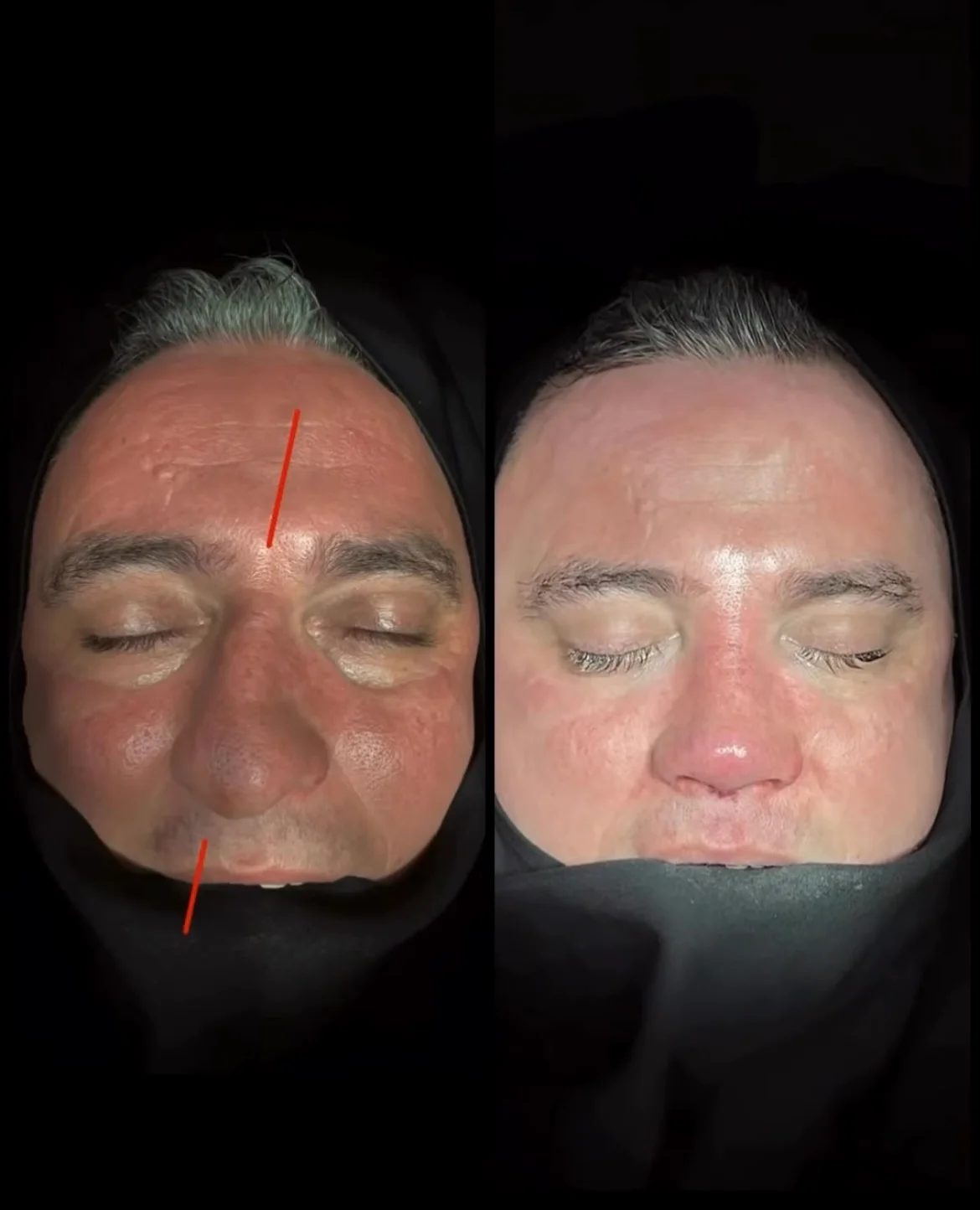 Crooked Nose Surgery Before & After Photos Gallery