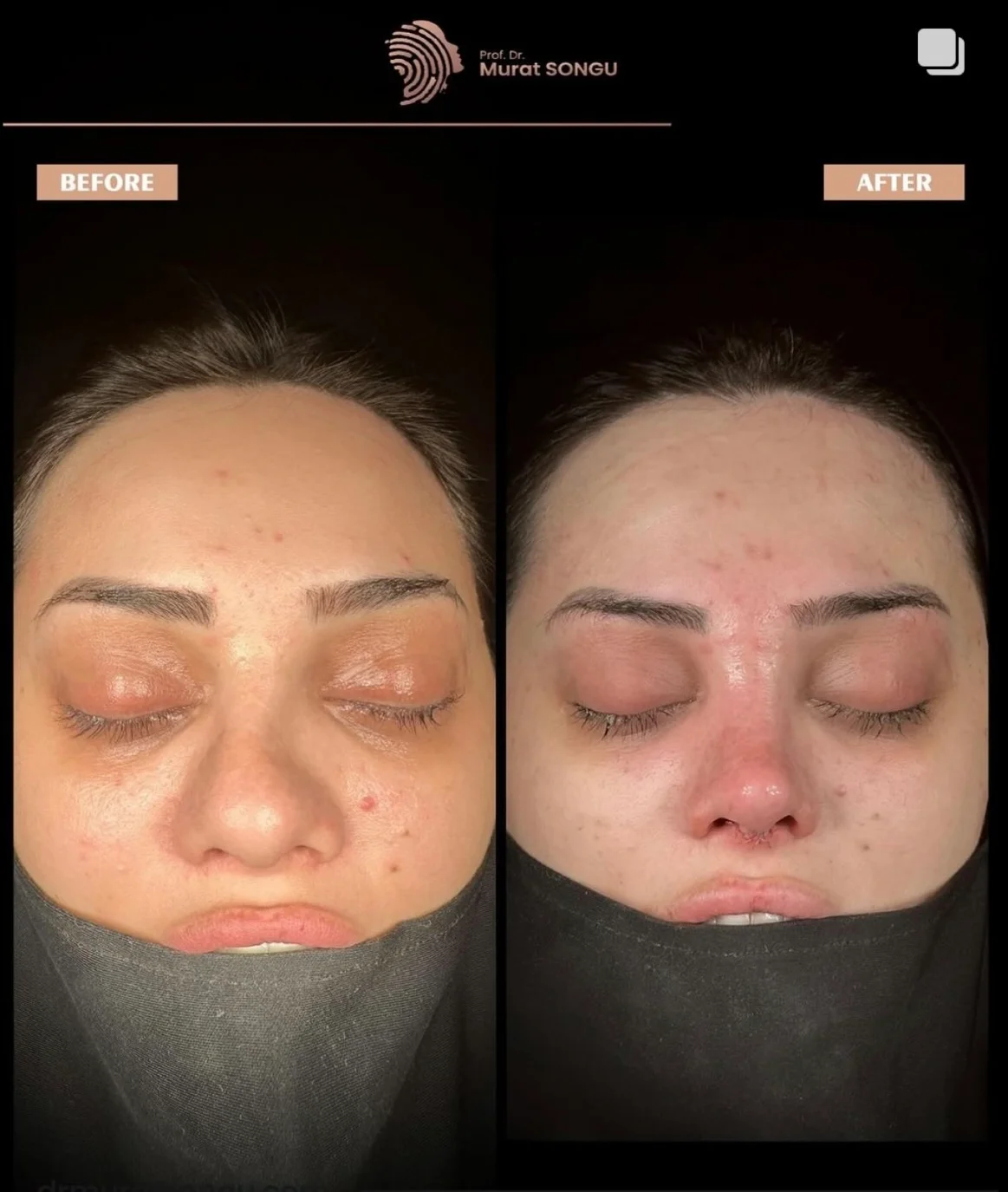 Crooked Nose Surgery Before & After Photos Gallery