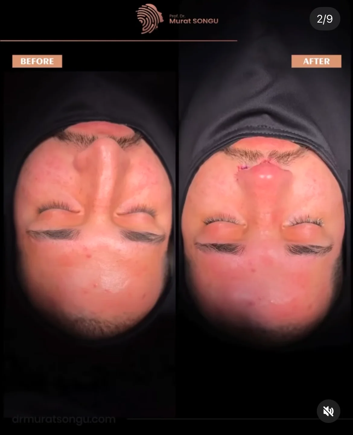 Crooked Nose Surgery Before & After Photos Gallery