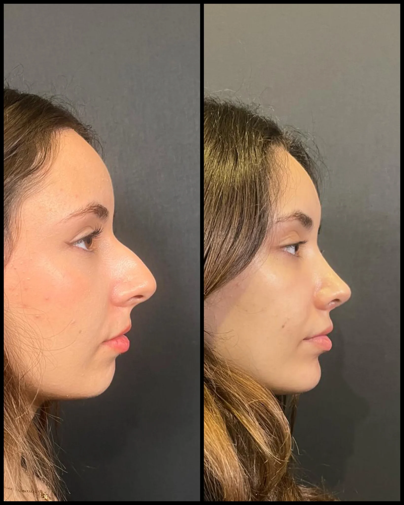 Hakeimplantater Før & Etter Hakeimplantater Før & Etter