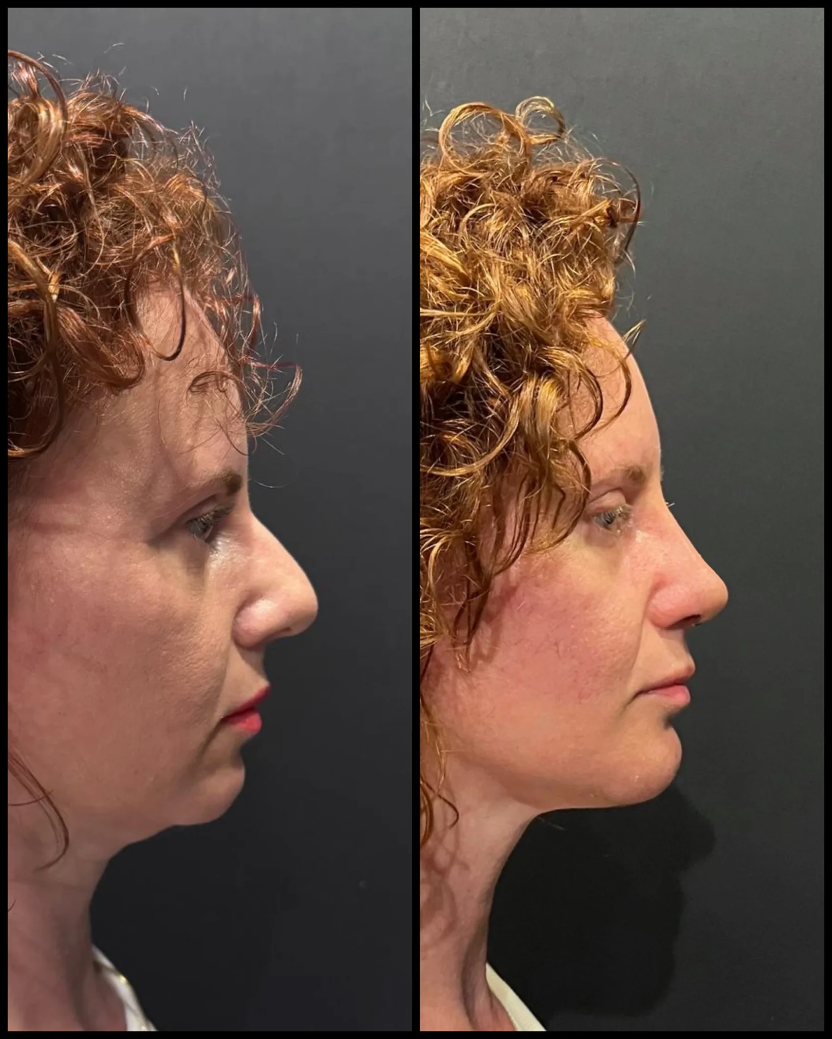 Hakeimplantater Før & Etter Hakeimplantater Før & Etter