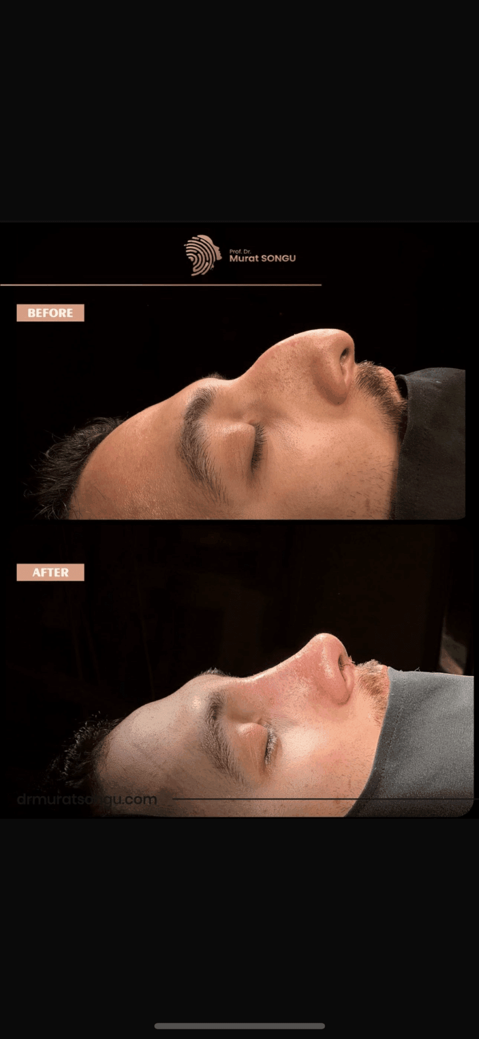Male Rhinoplasty Before and After Photos