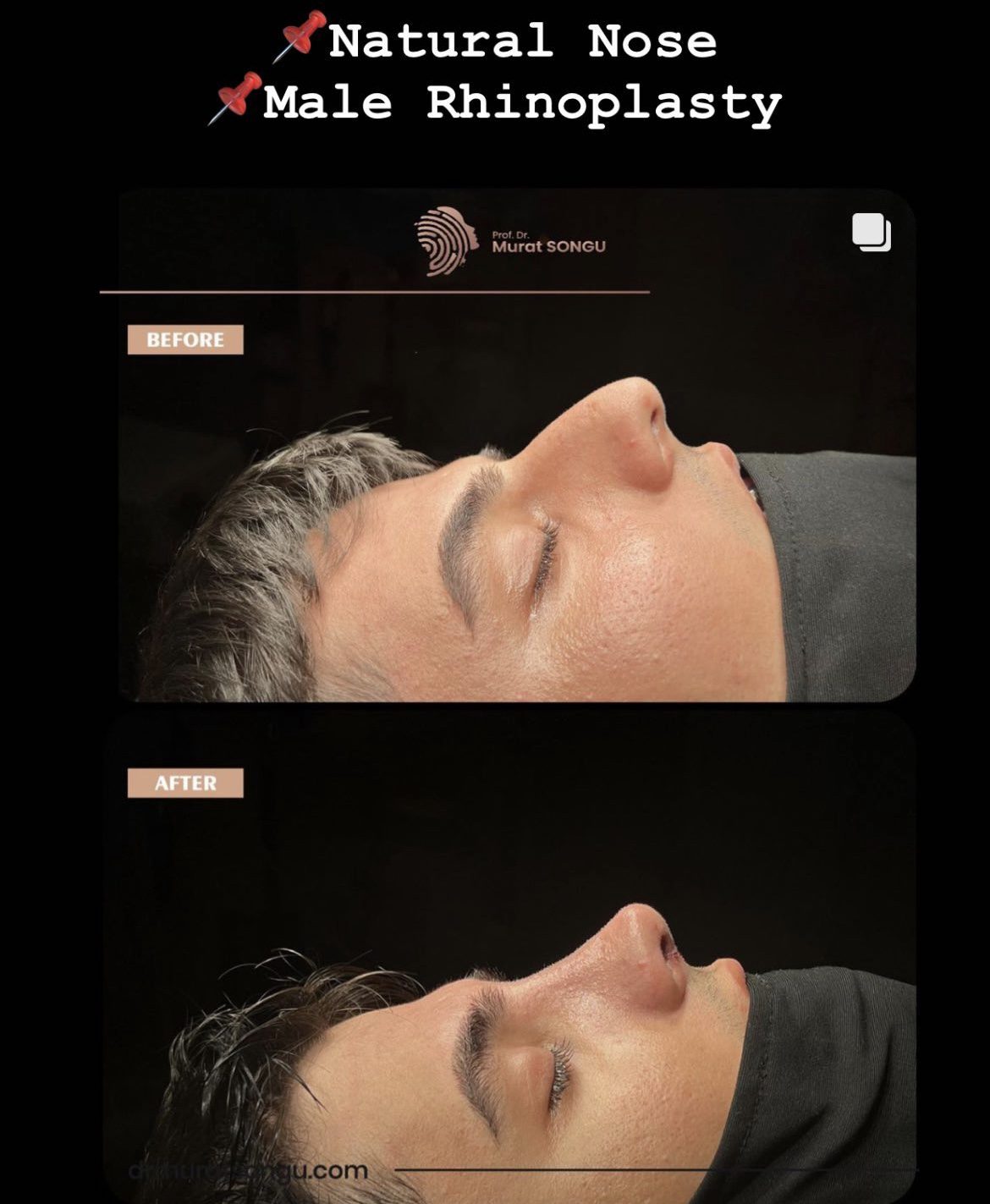 Male Rhinoplasty Before and After Photos