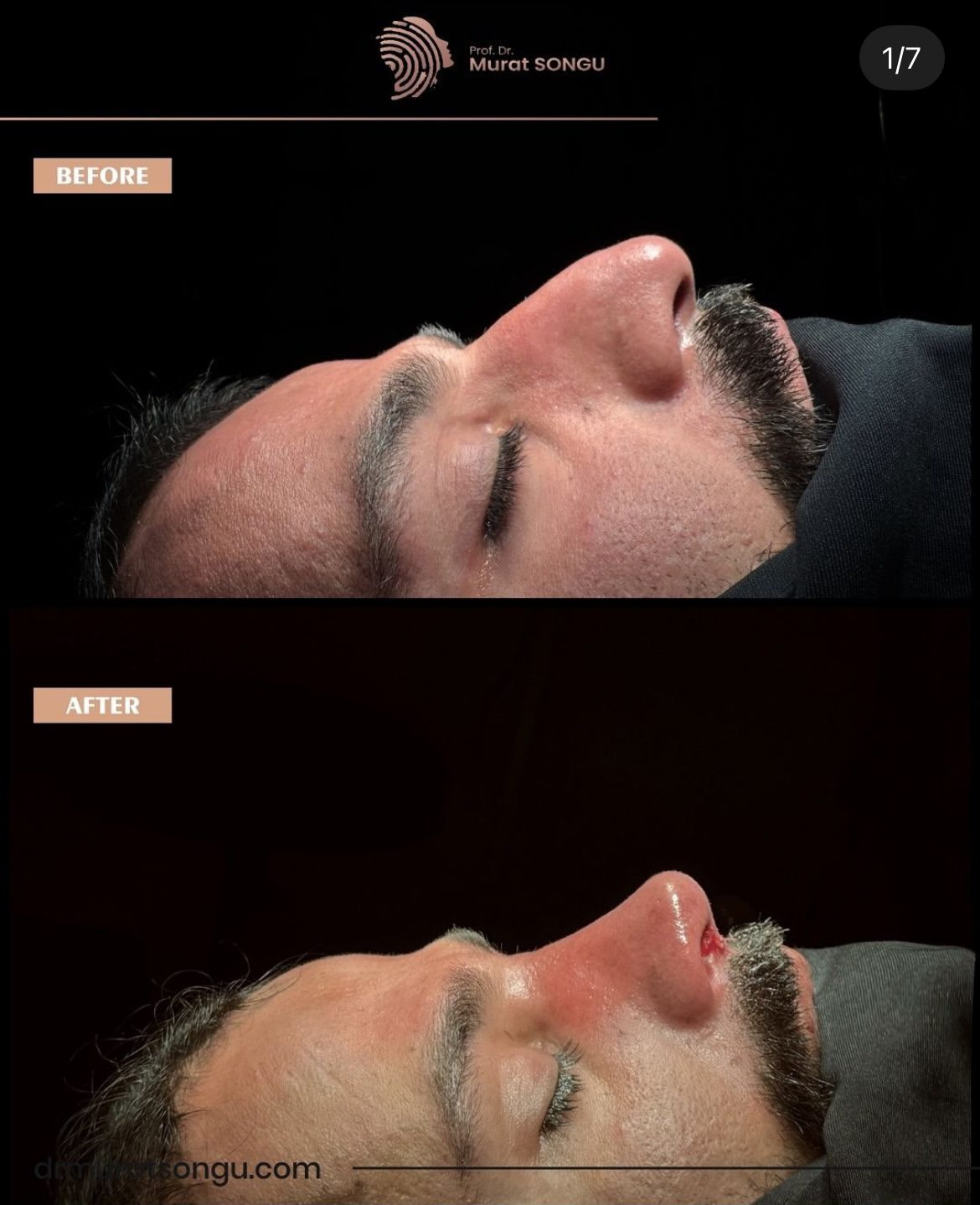 Male Rhinoplasty Before and After Photos