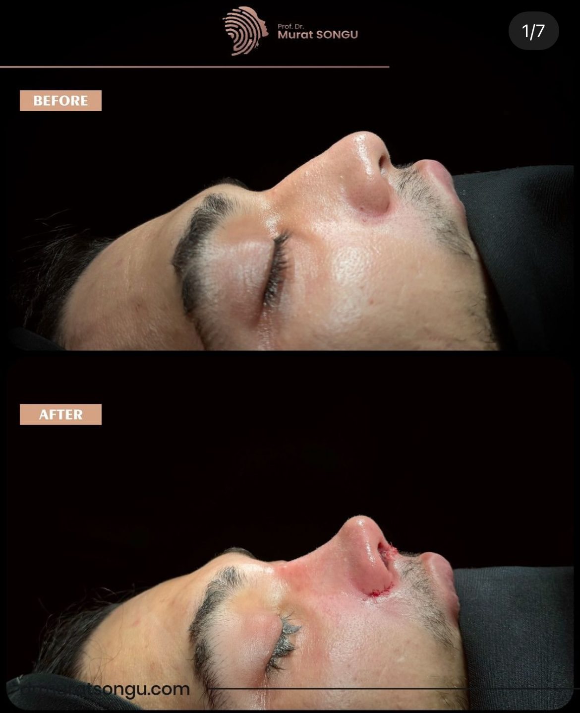 Male Rhinoplasty Before and After Photos