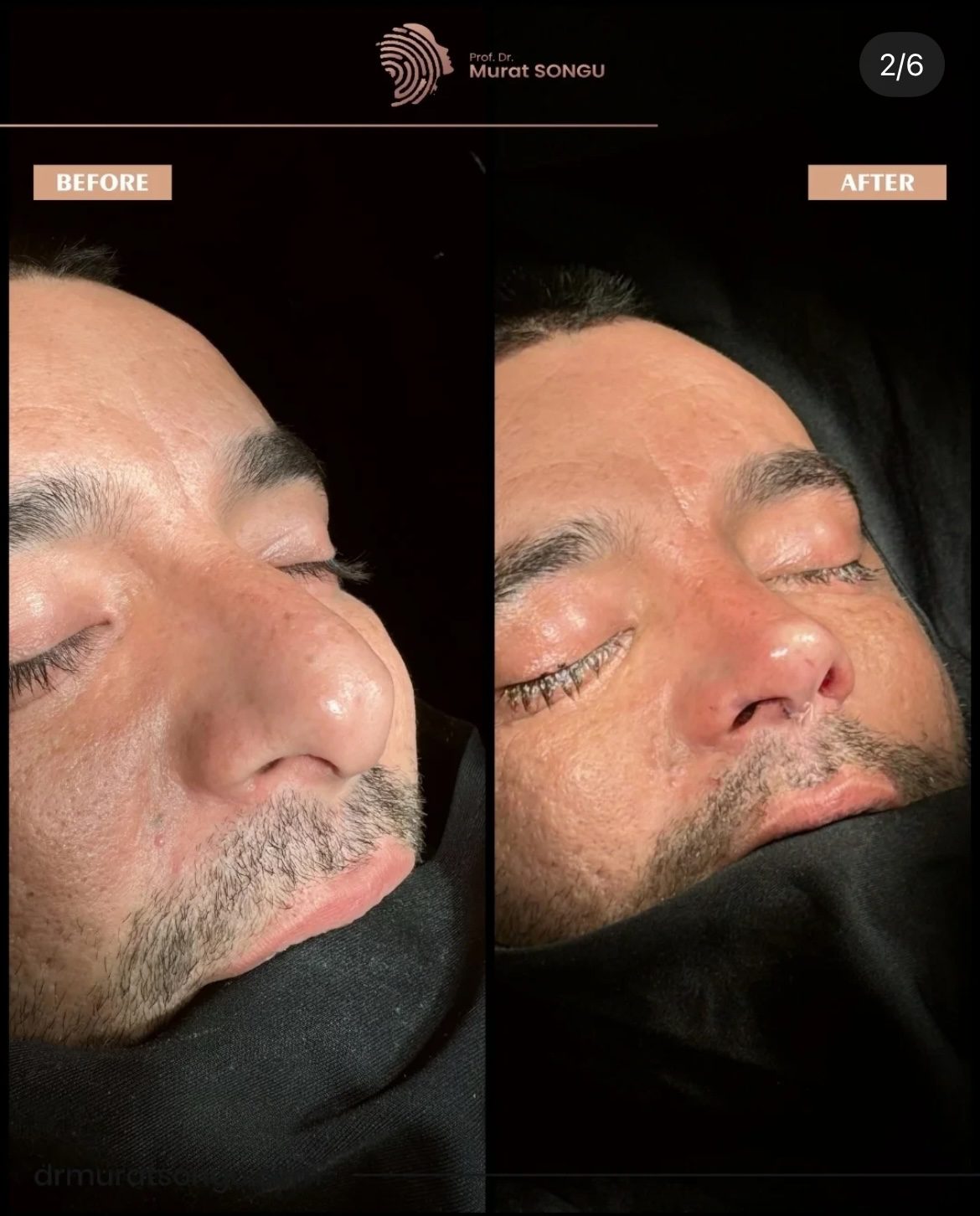 Male Rhinoplasty Before and After Photos