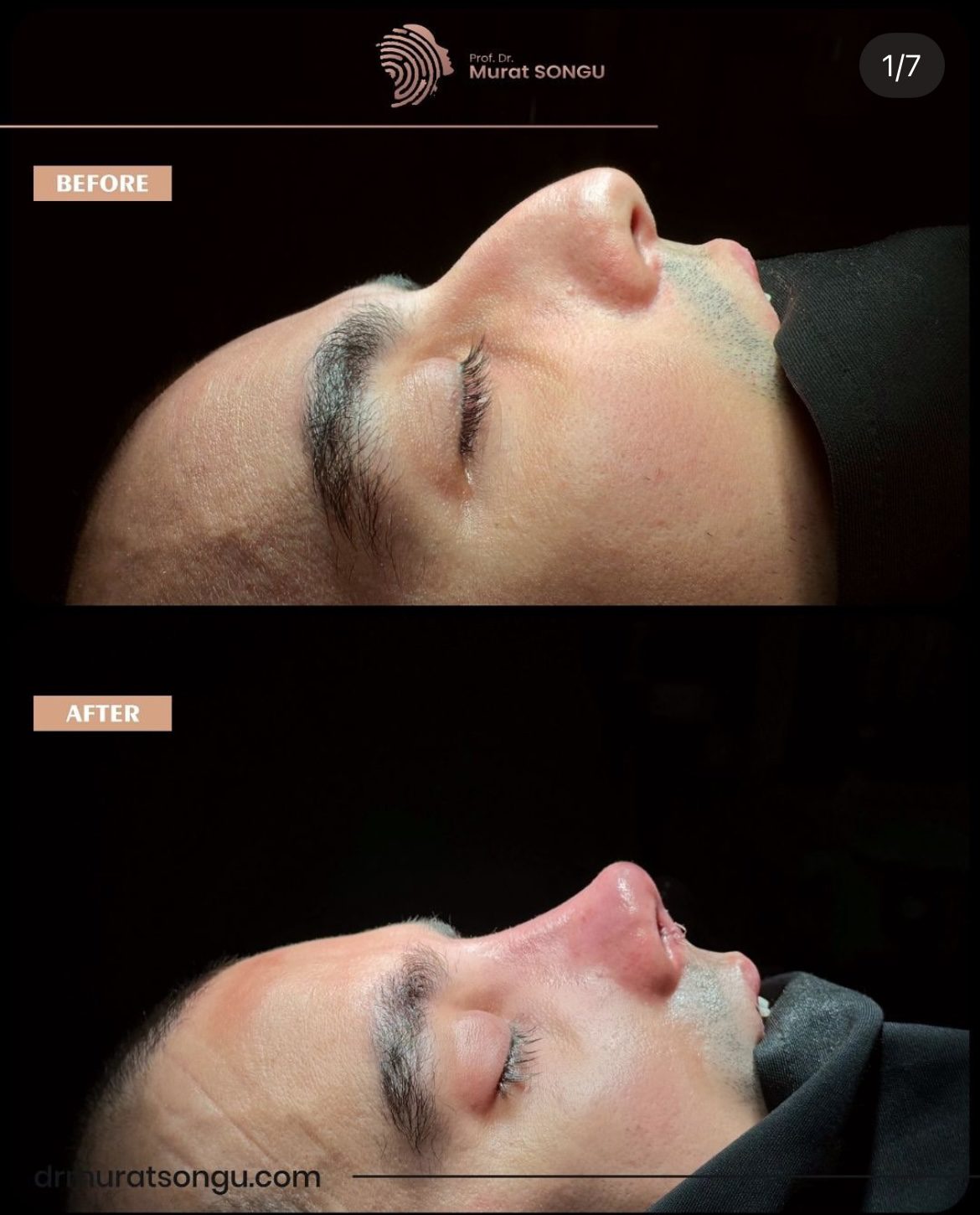 Male Rhinoplasty Before and After Photos
