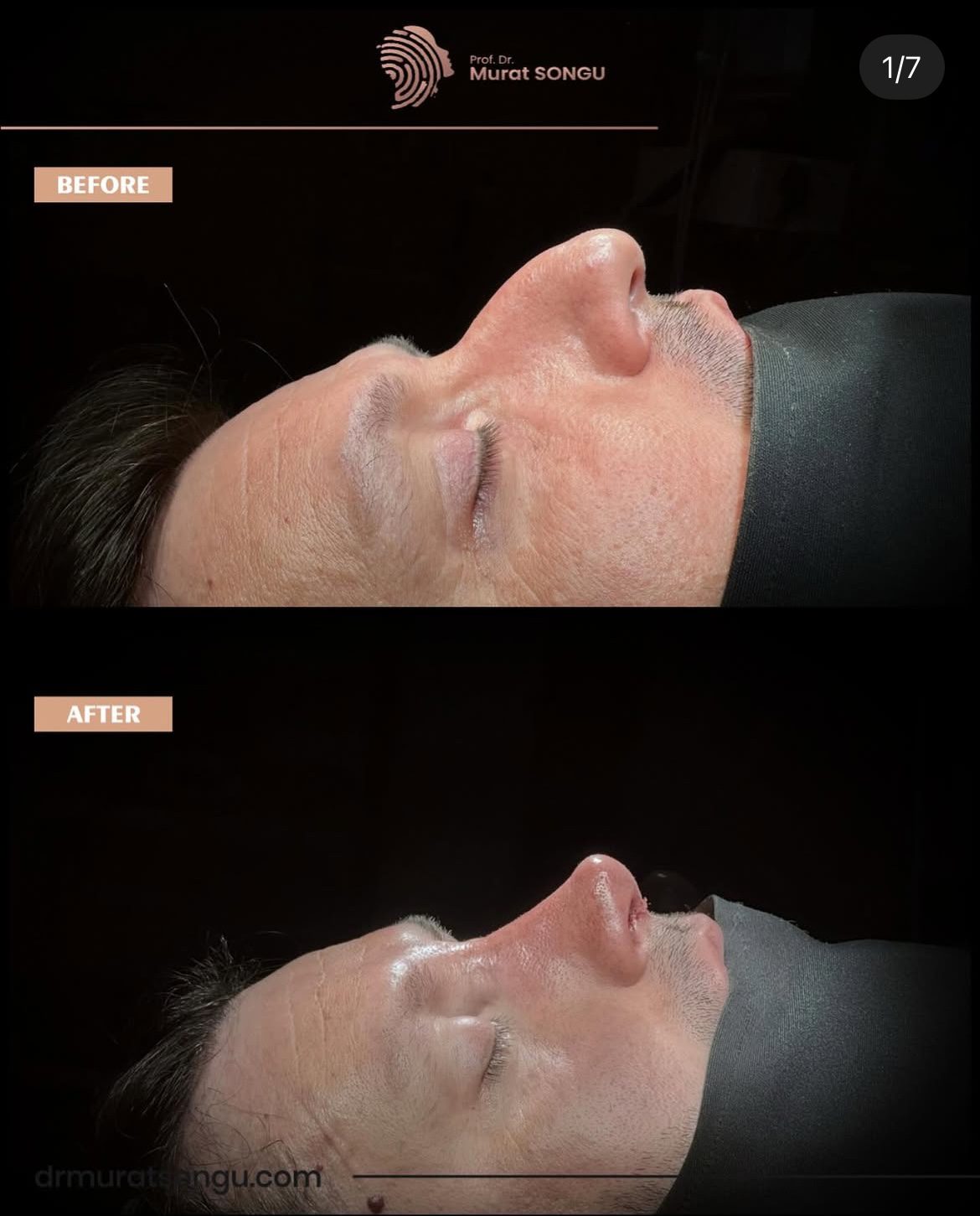 Male Rhinoplasty Before and After Photos