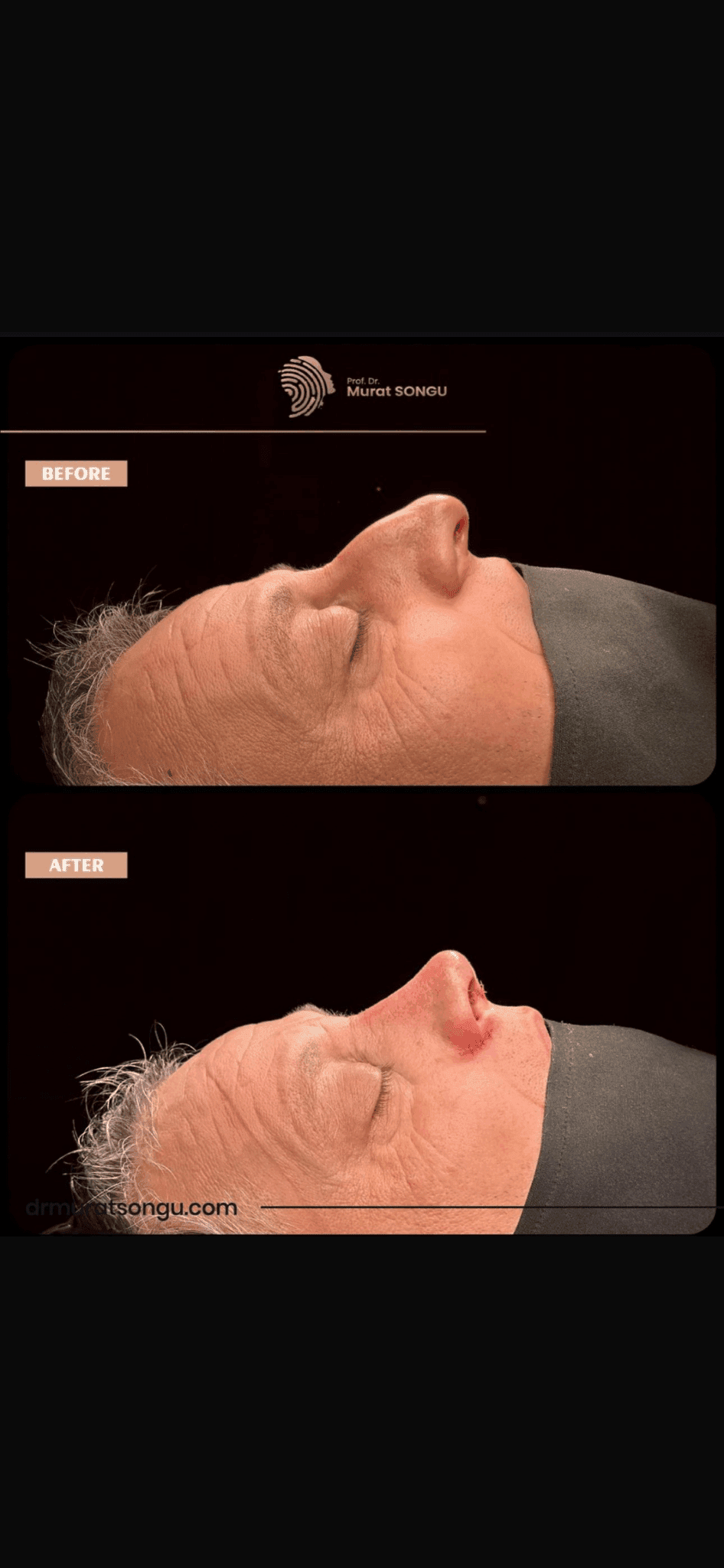 Male Rhinoplasty Before and After Photos