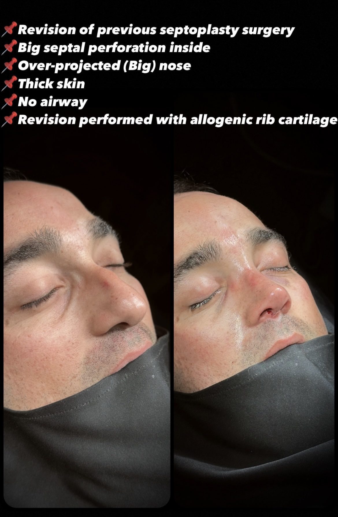 Male Rhinoplasty Before and After Photos
