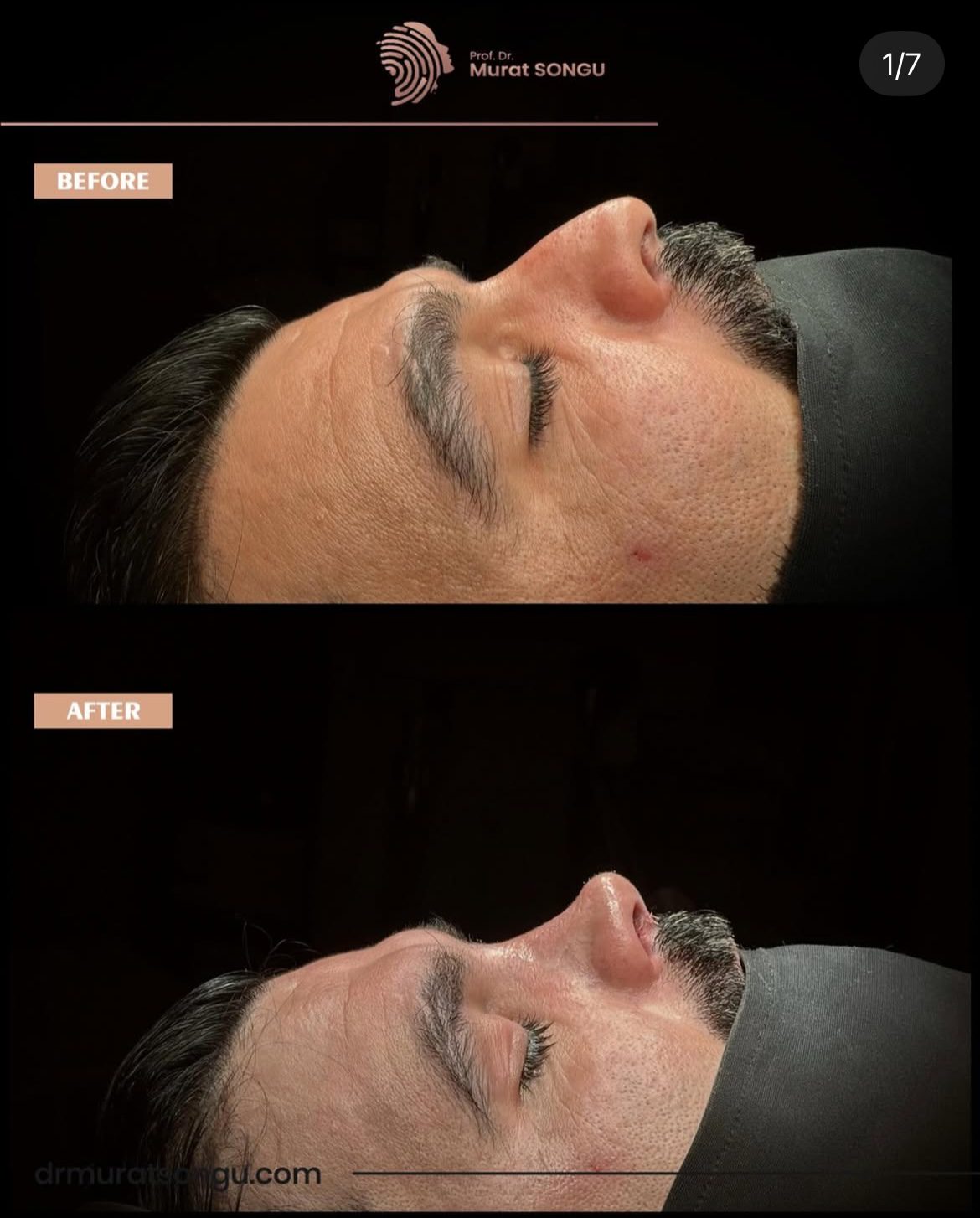 Male Rhinoplasty Before and After Photos