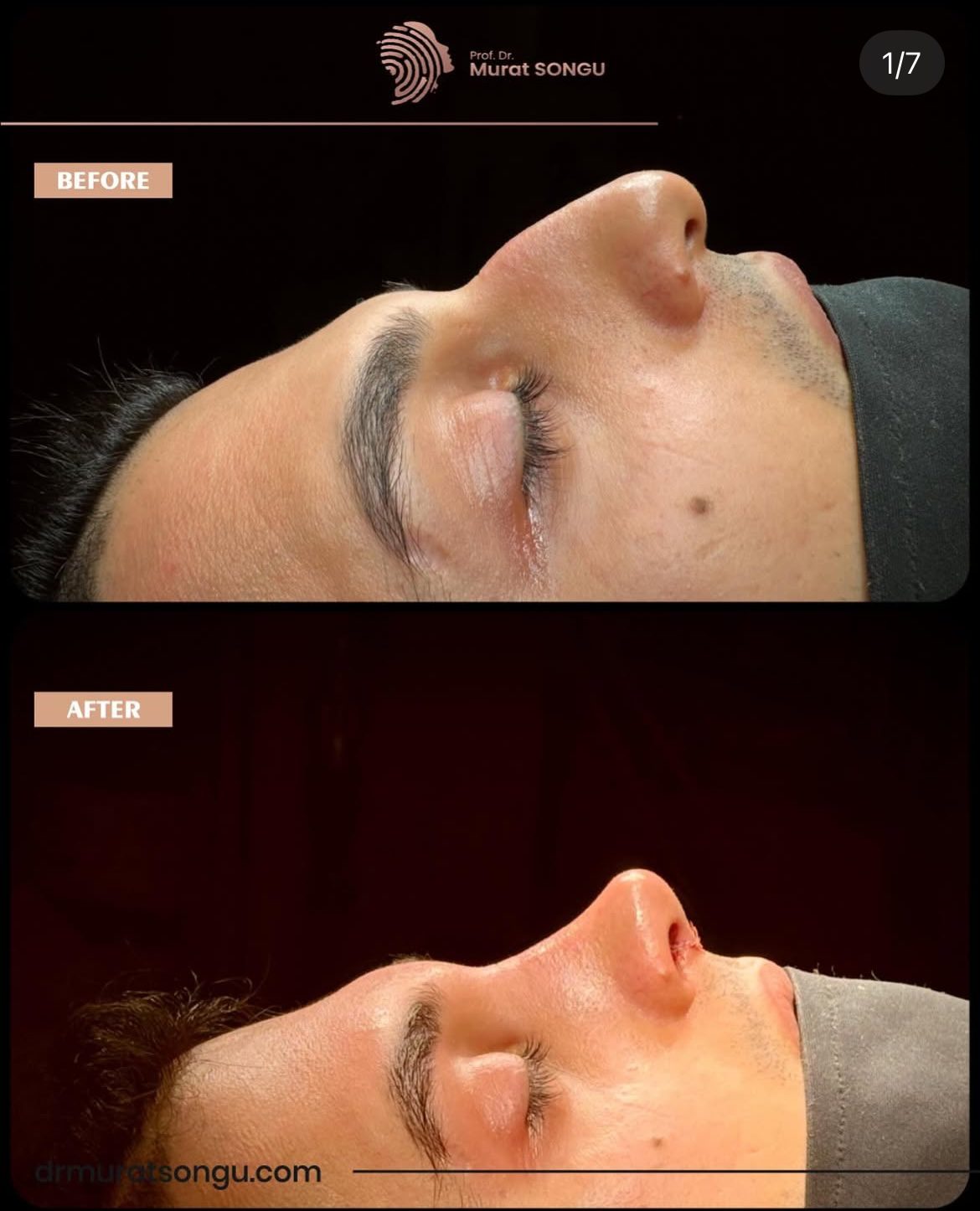 Male Rhinoplasty Before and After Photos