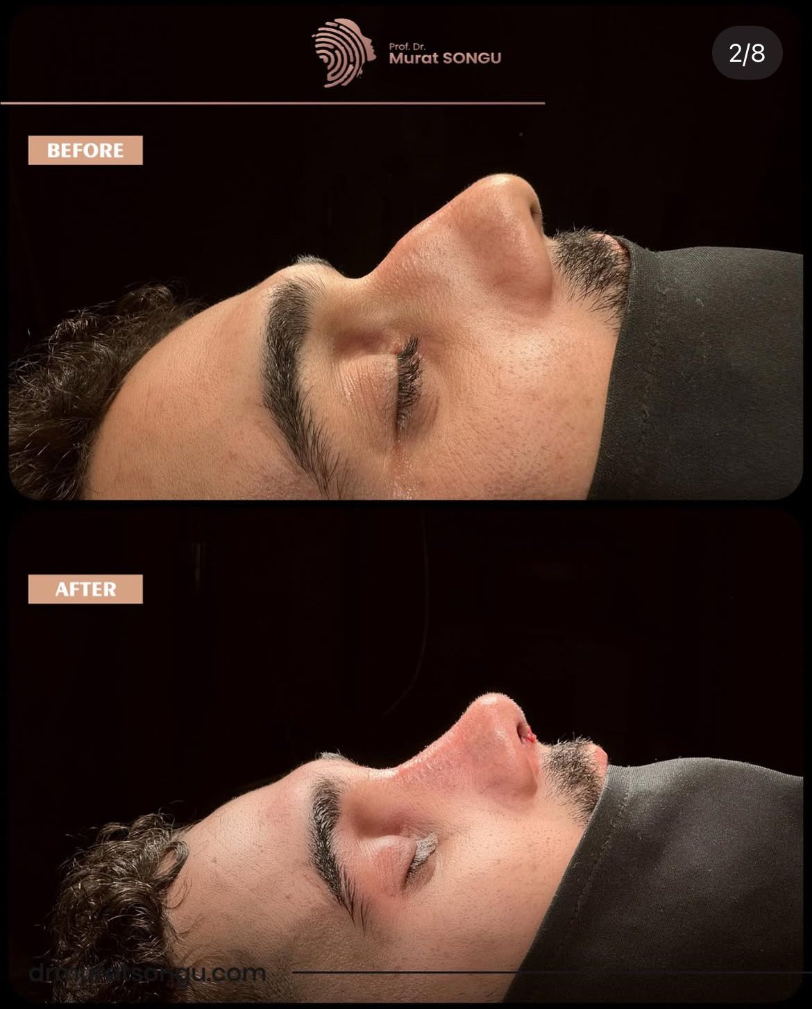 Male Rhinoplasty Before and After Photos