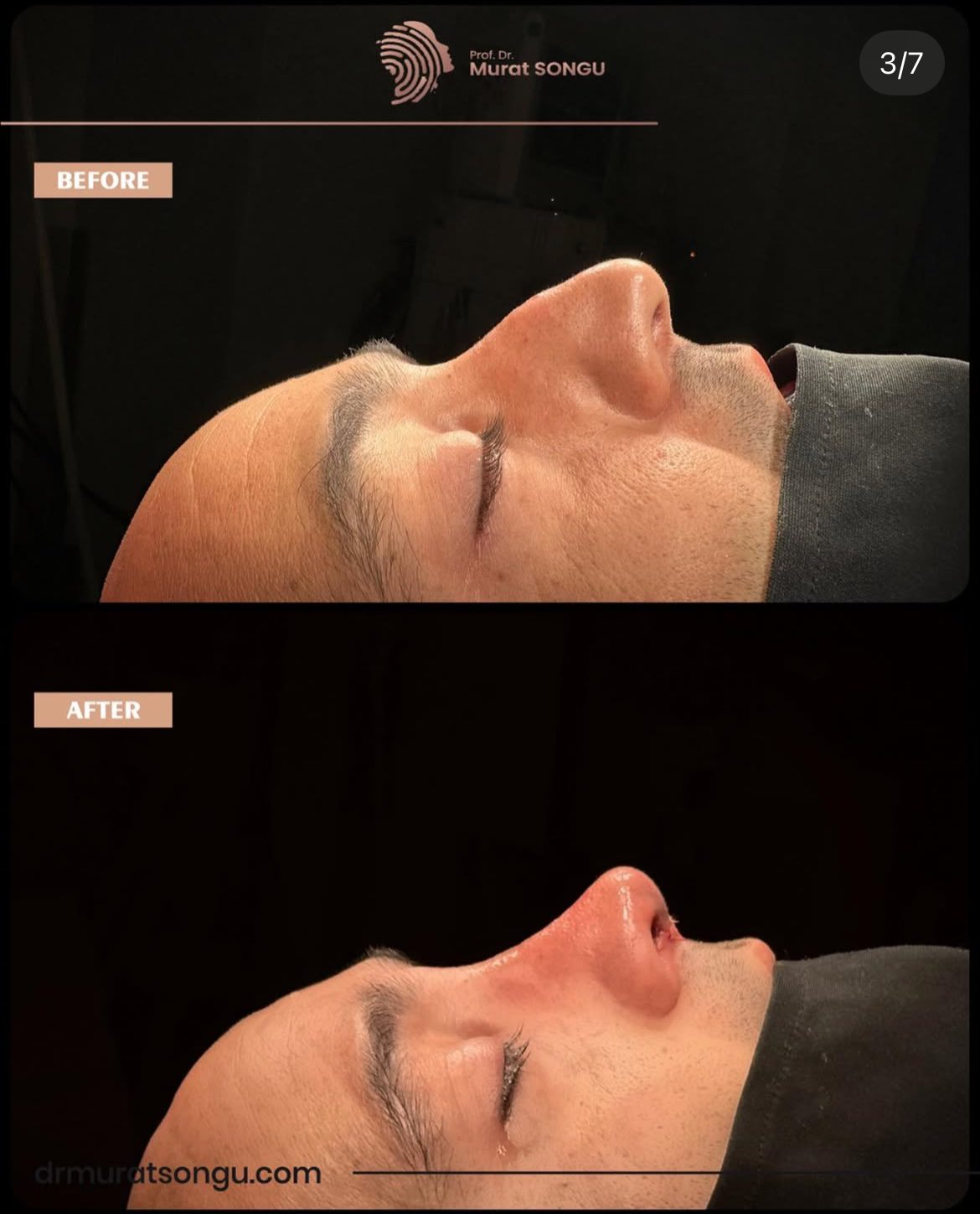 Male Rhinoplasty Before and After Photos