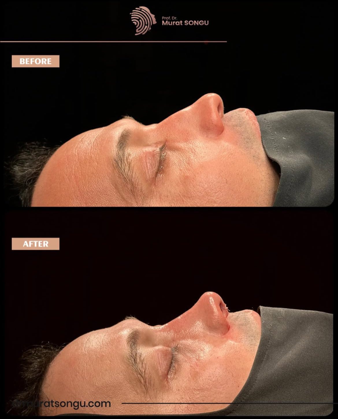 Male Rhinoplasty Before and After Photos