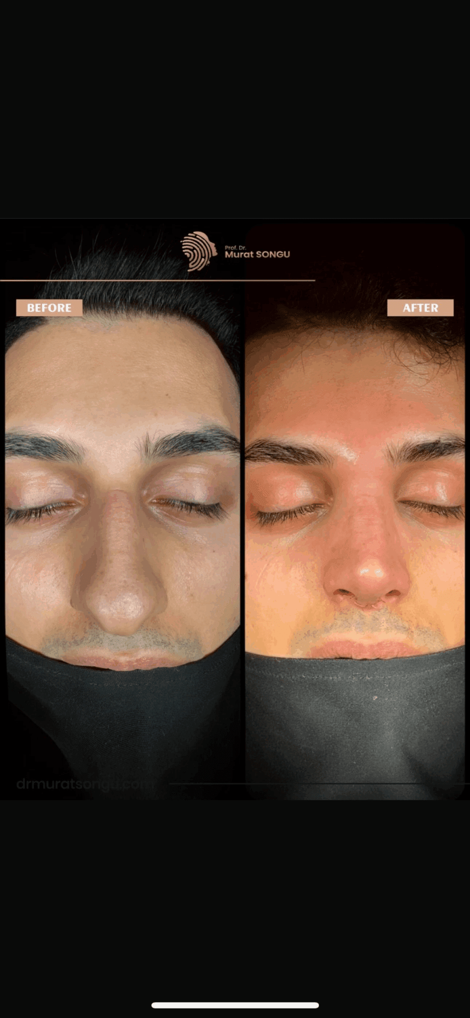Male Rhinoplasty Before and After Photos