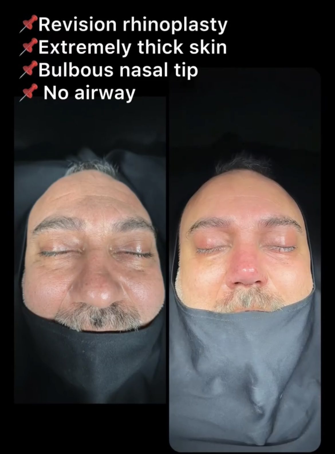 Male Rhinoplasty Before and After Photos